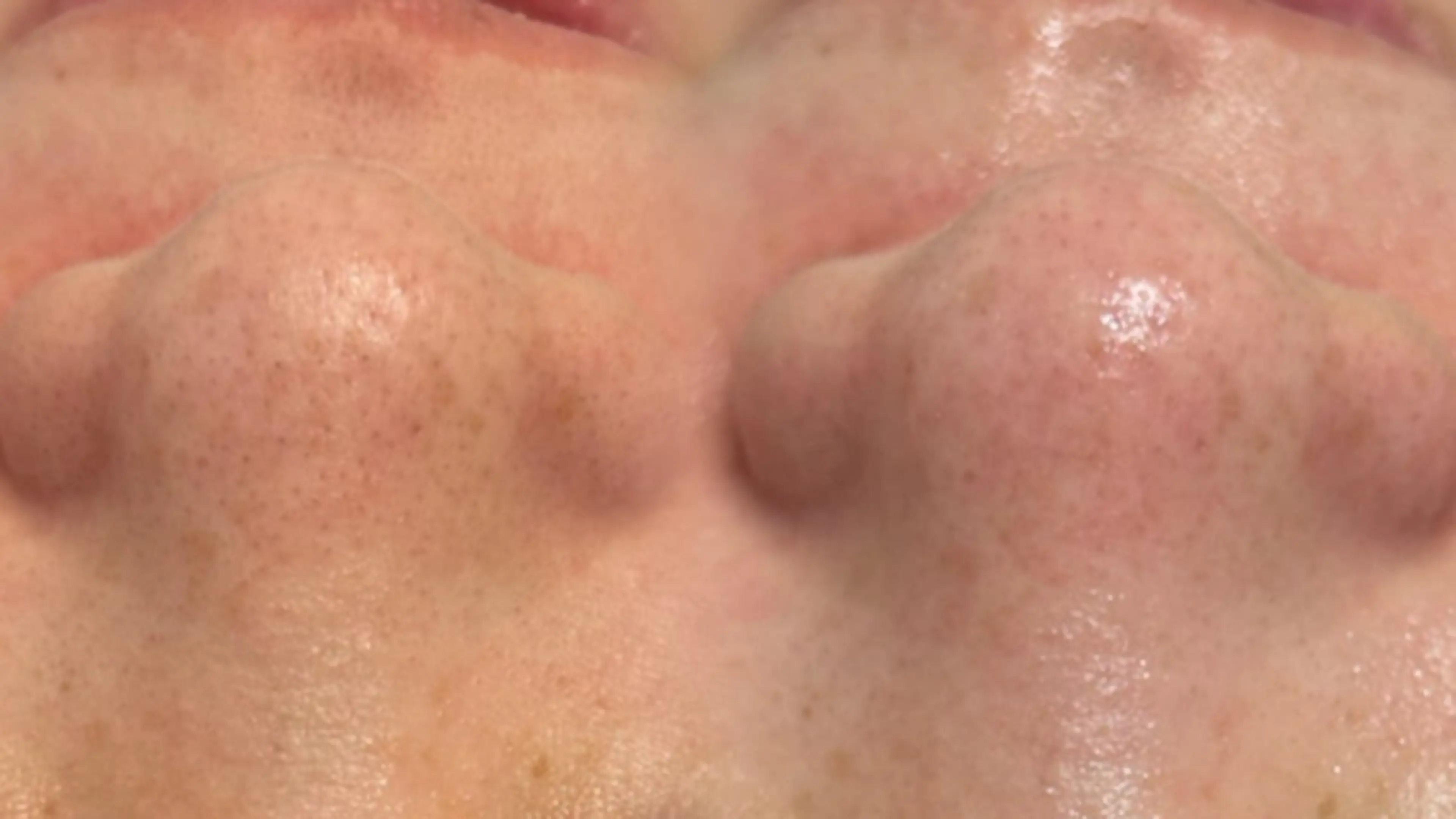 【浮かせて吸い取る】毛穴洗浄の写真