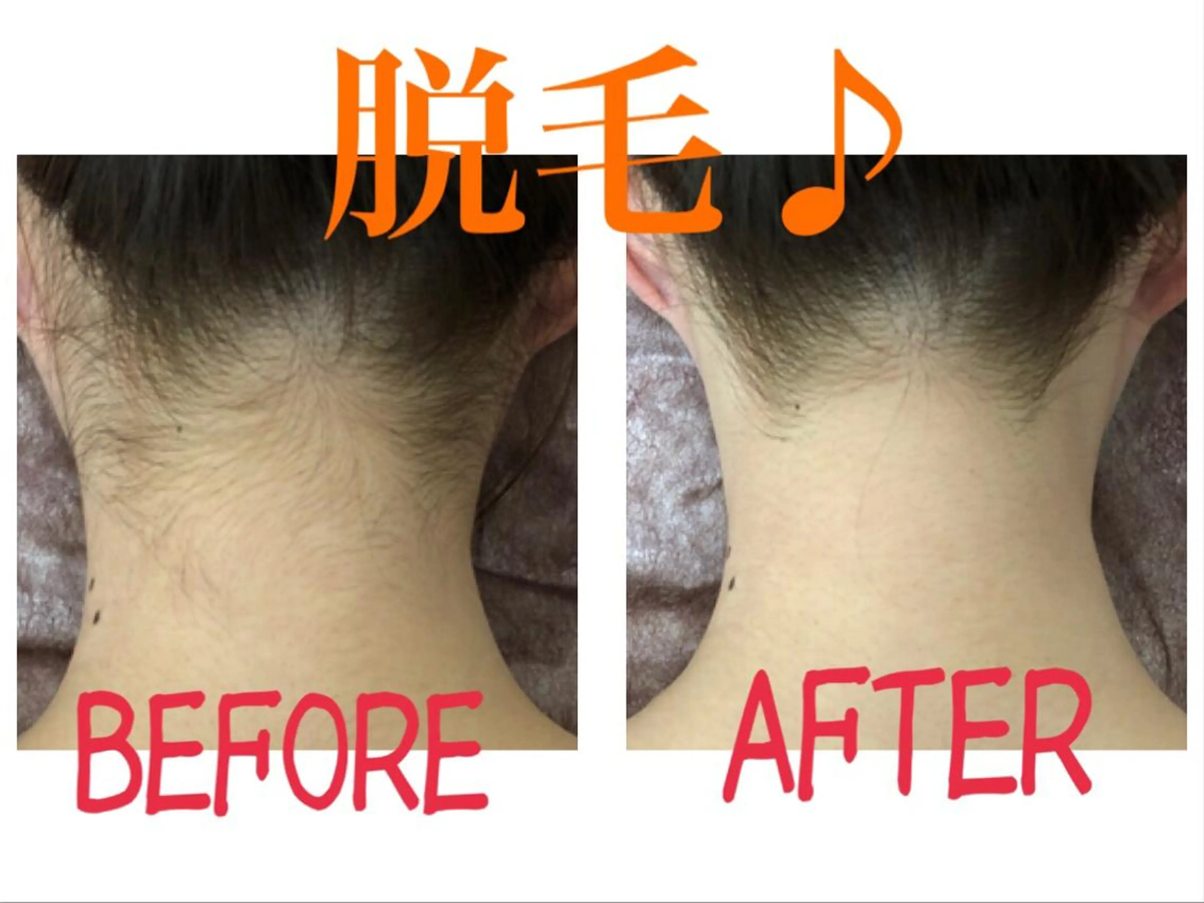 ❤️【うなじ】脱毛モニター募集🎀3回3,900円❤️自分で処理が難しいうなじ😭💦イベント前にも💓の写真