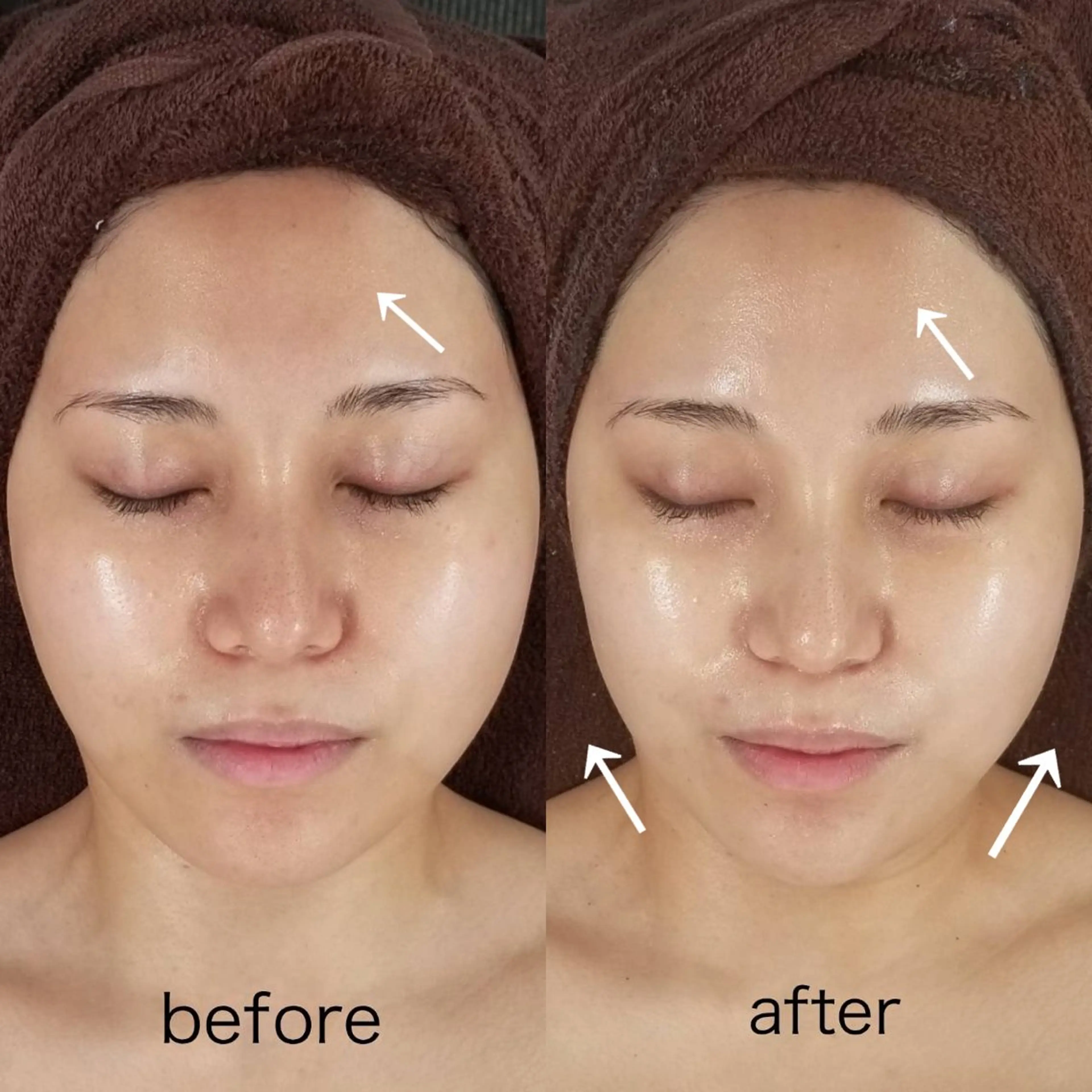 👑【美の最上級】REVIハーブピーリング《陶肌トリートメント》 ➕ オプション7つ全部入れ！ / 今すぐ差がつくお肌への写真