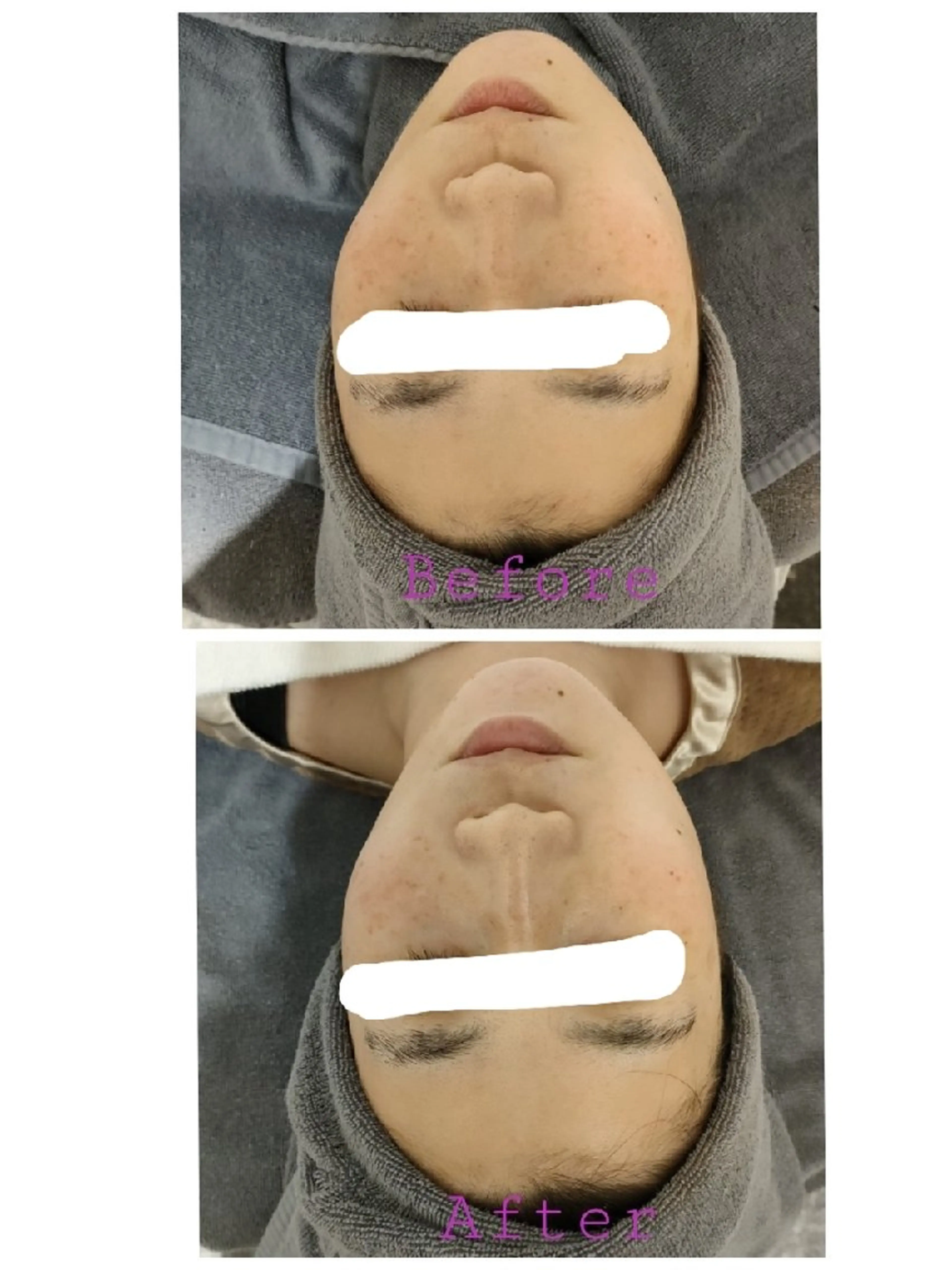 美肌エイジングケアコースの写真