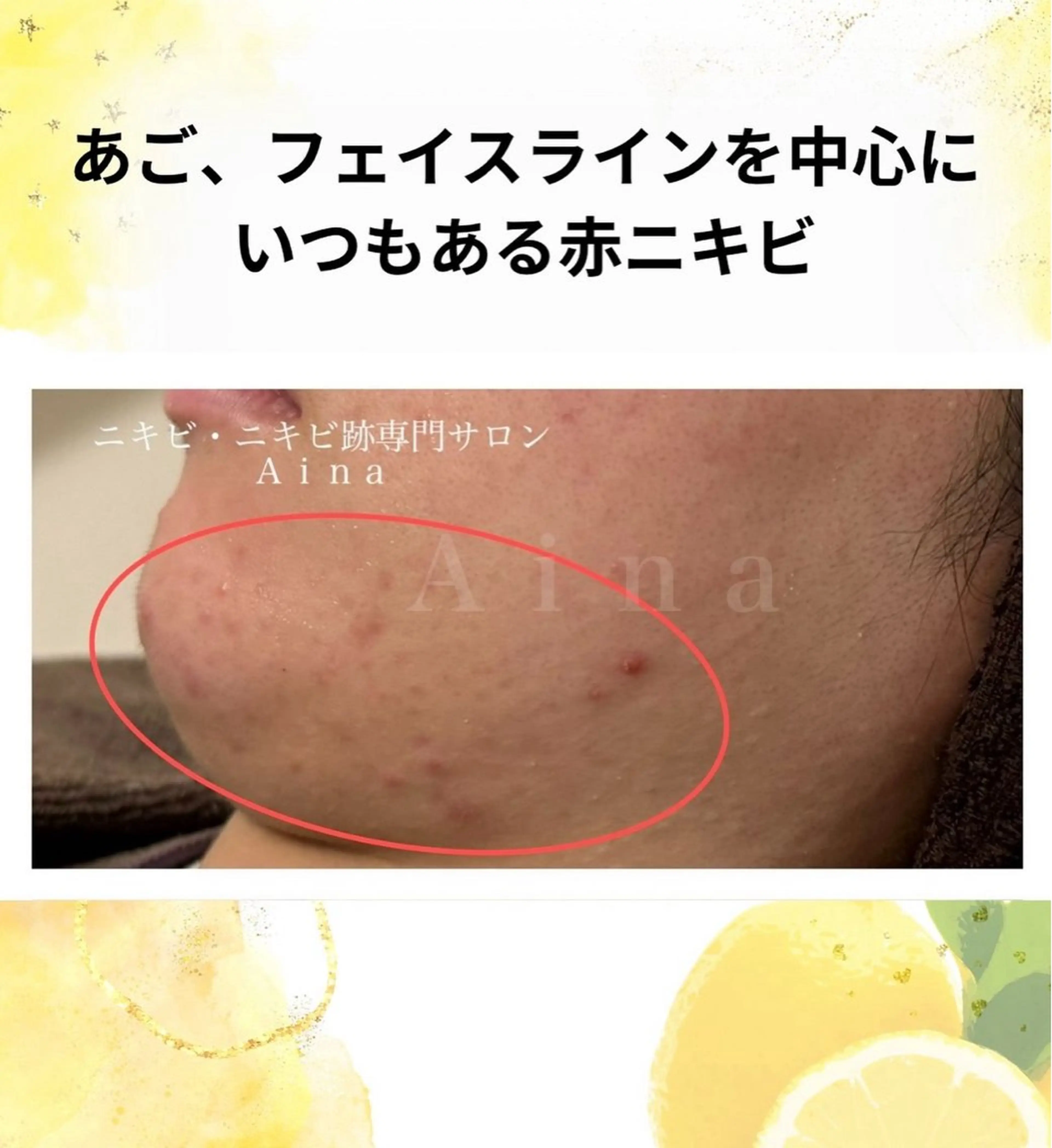 エステ リラク ニキビ跡専門サロン Ａｉｎａのエステ・リラクイメージ