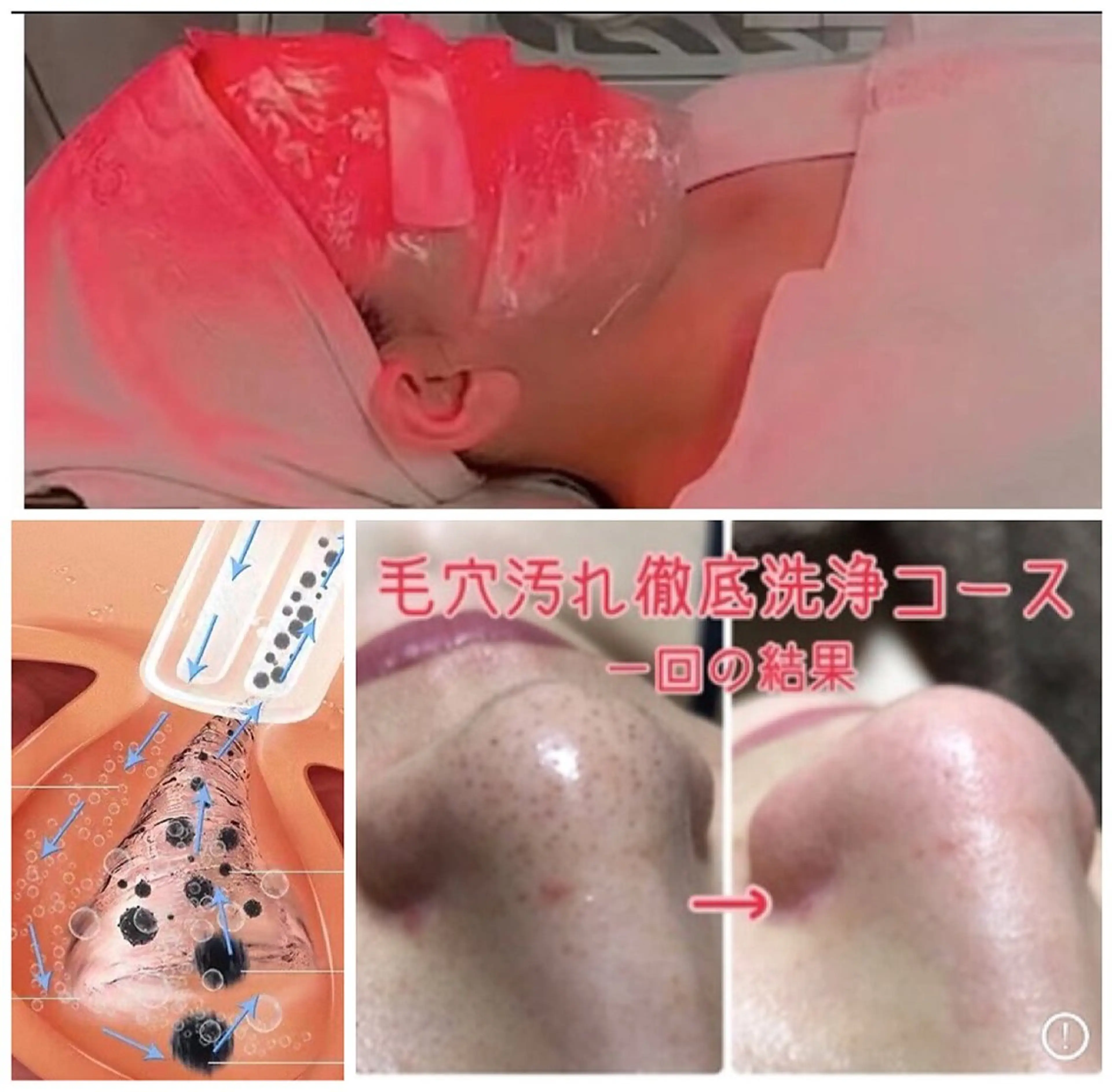 毛穴角栓洗浄吸引・黒ずみ対策ハイドラフェイシャル60分の写真