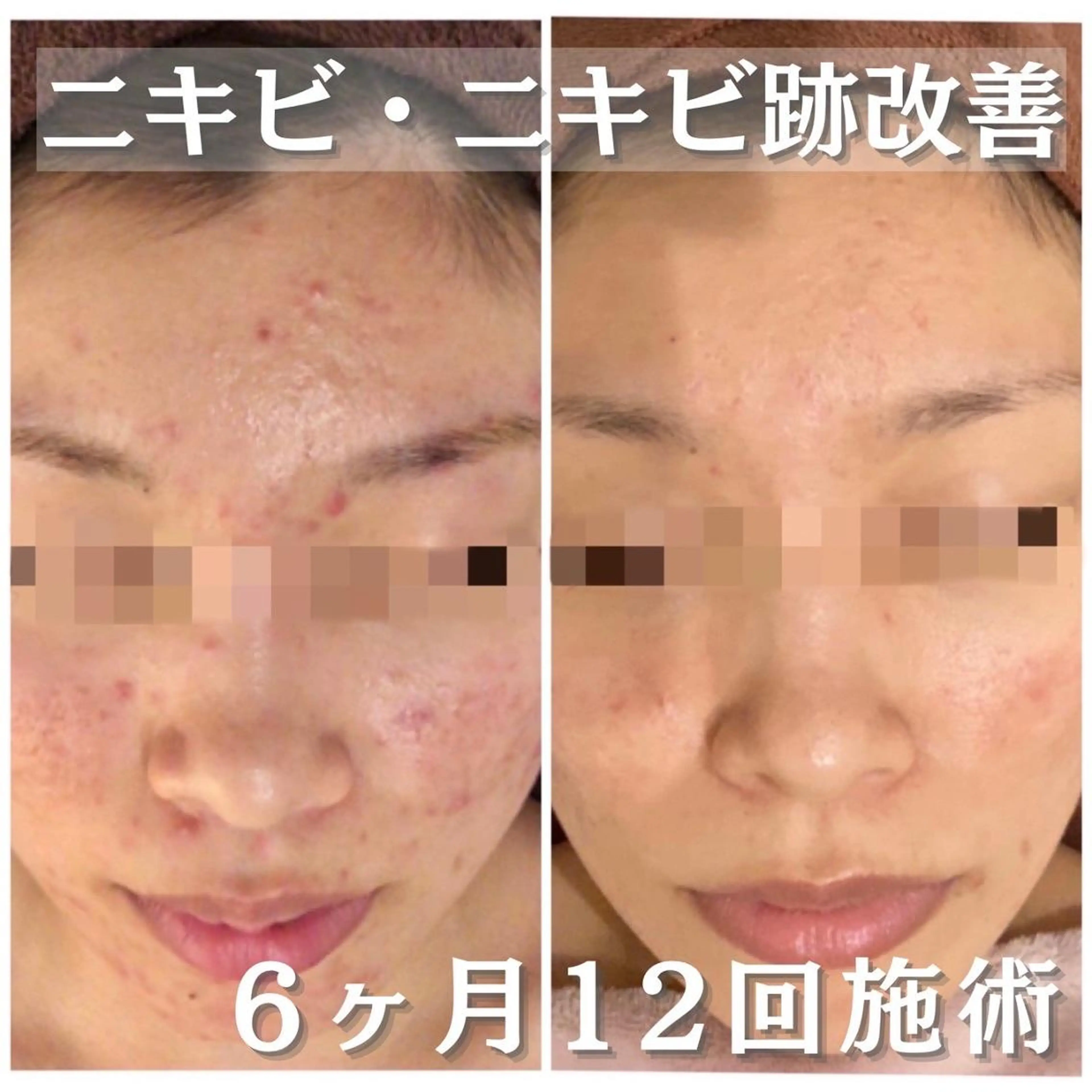 3か月で肌革命👼 ニキビ専門店💫のエステ・リラクイメージ