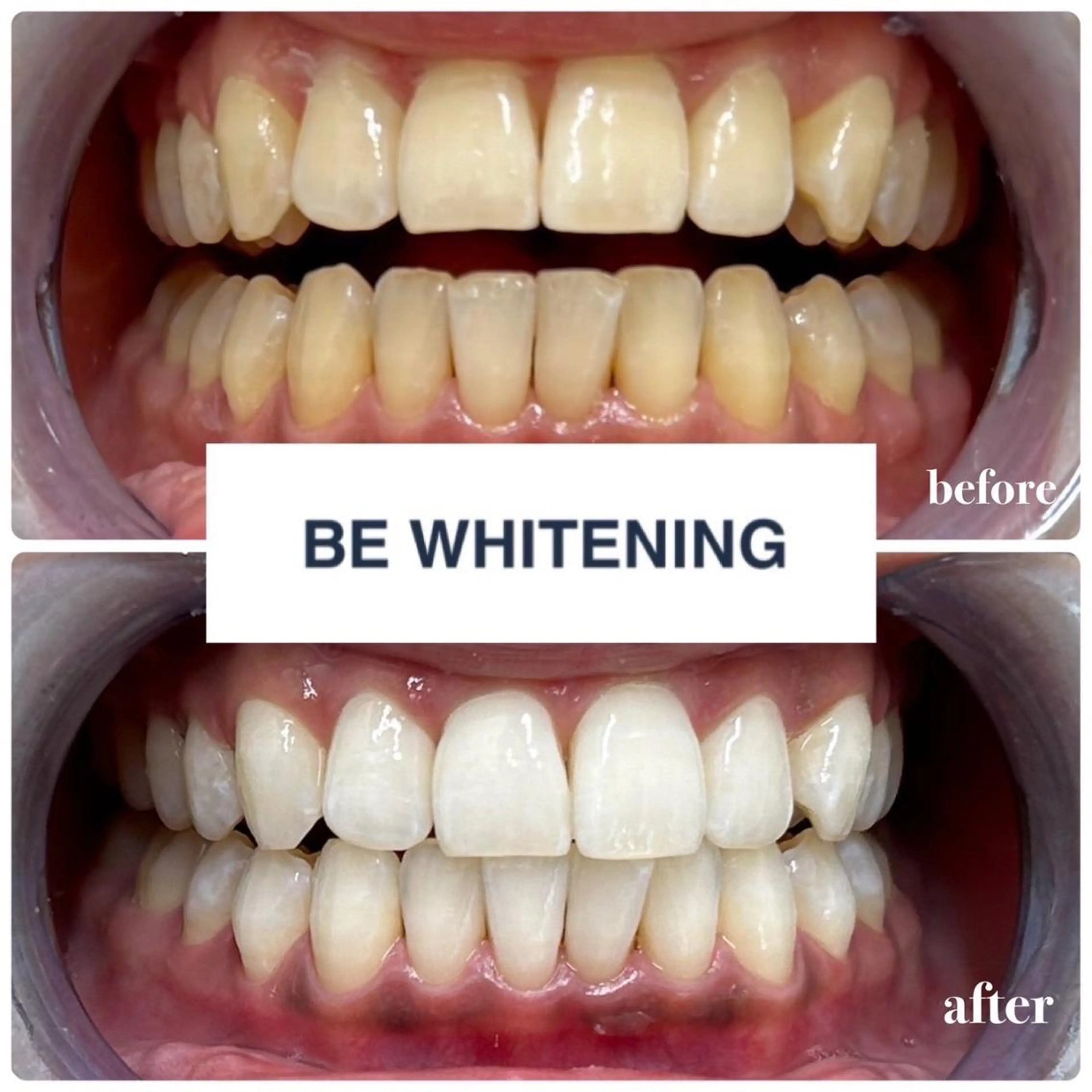 【🚨短期集中ホワイトニング🚨】ホワイトニング3週間通い放題￥33,000(1日15分照射×2回)安心の最低保証付⭐️の写真