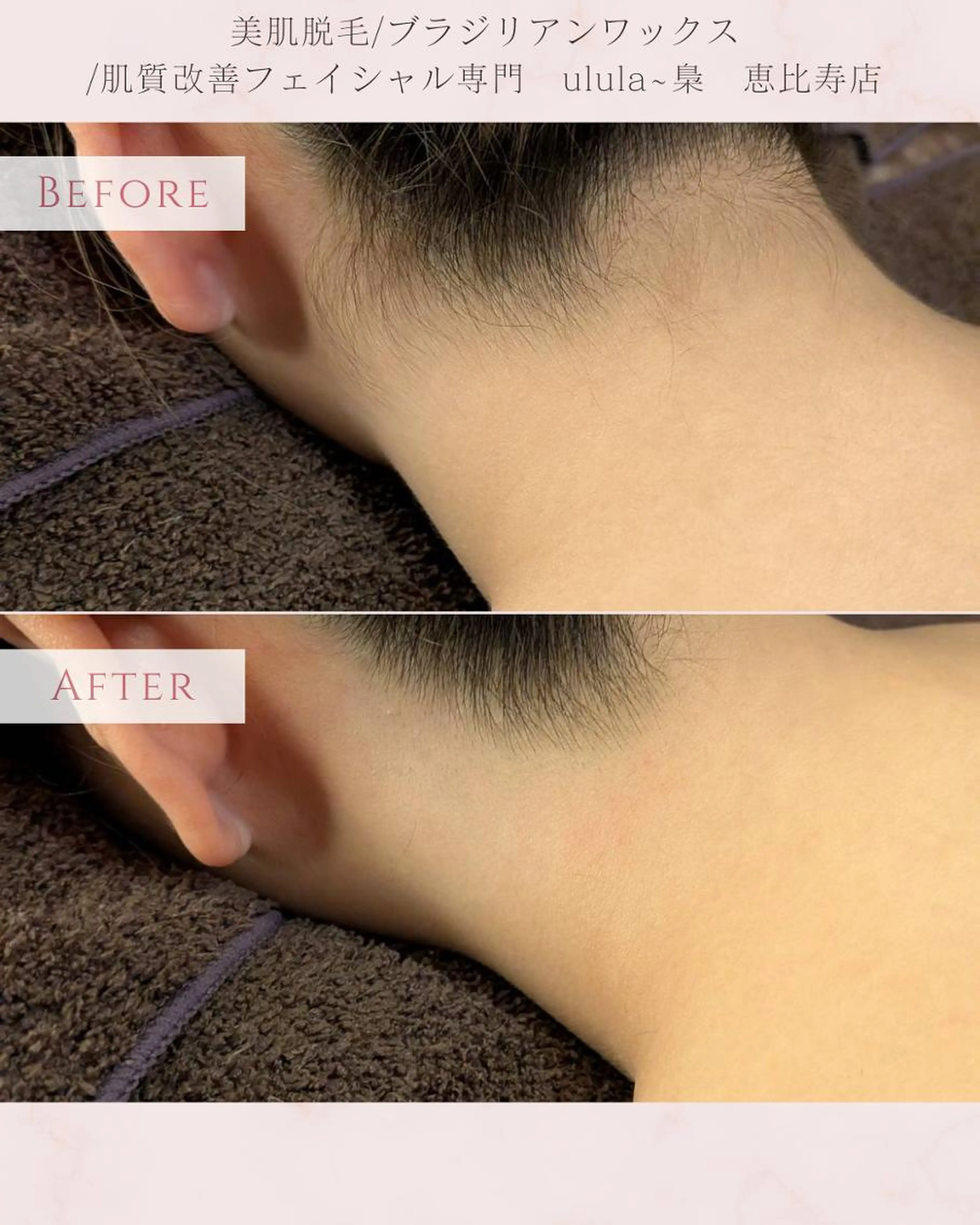 【ミニモ学割U24】垢抜け全身✨全身脱毛(VIO込)¥7,800の写真