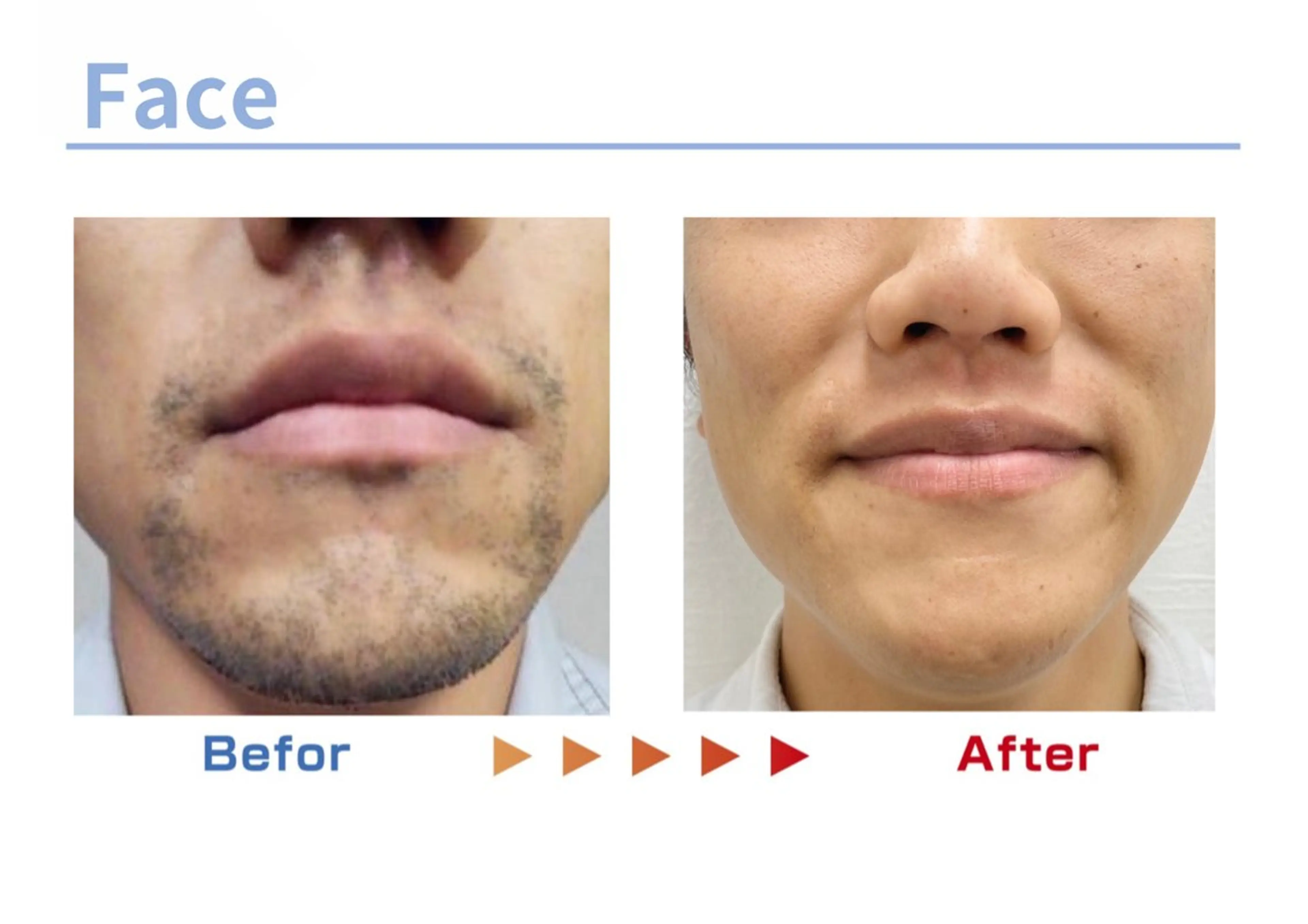 セルフ脱毛/美尻イス キングスサロン熊本のエステ・リラクイメージ