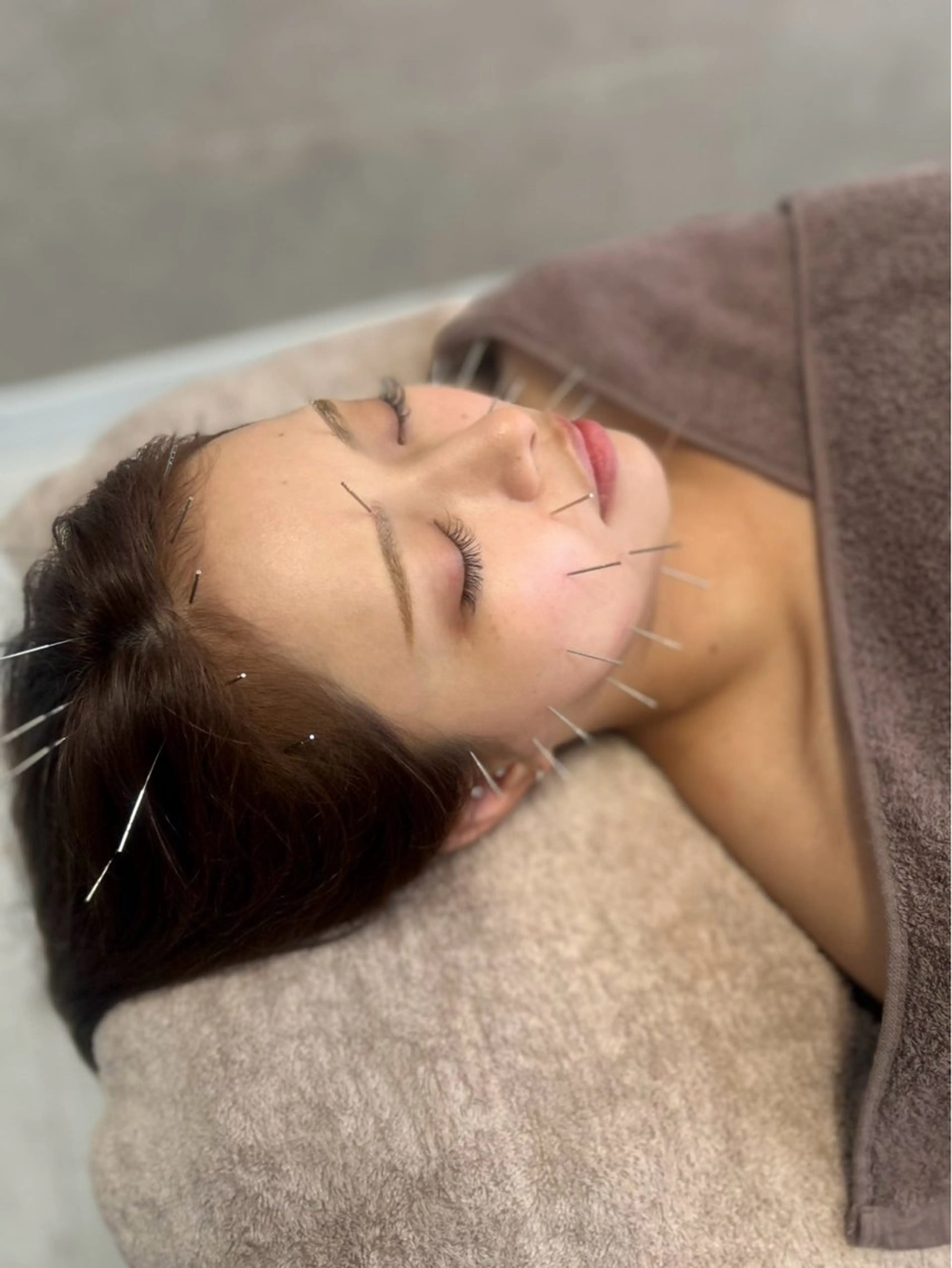 新規限定✨内側から綺麗に‼︎美容鍼の小顔コース💖の写真