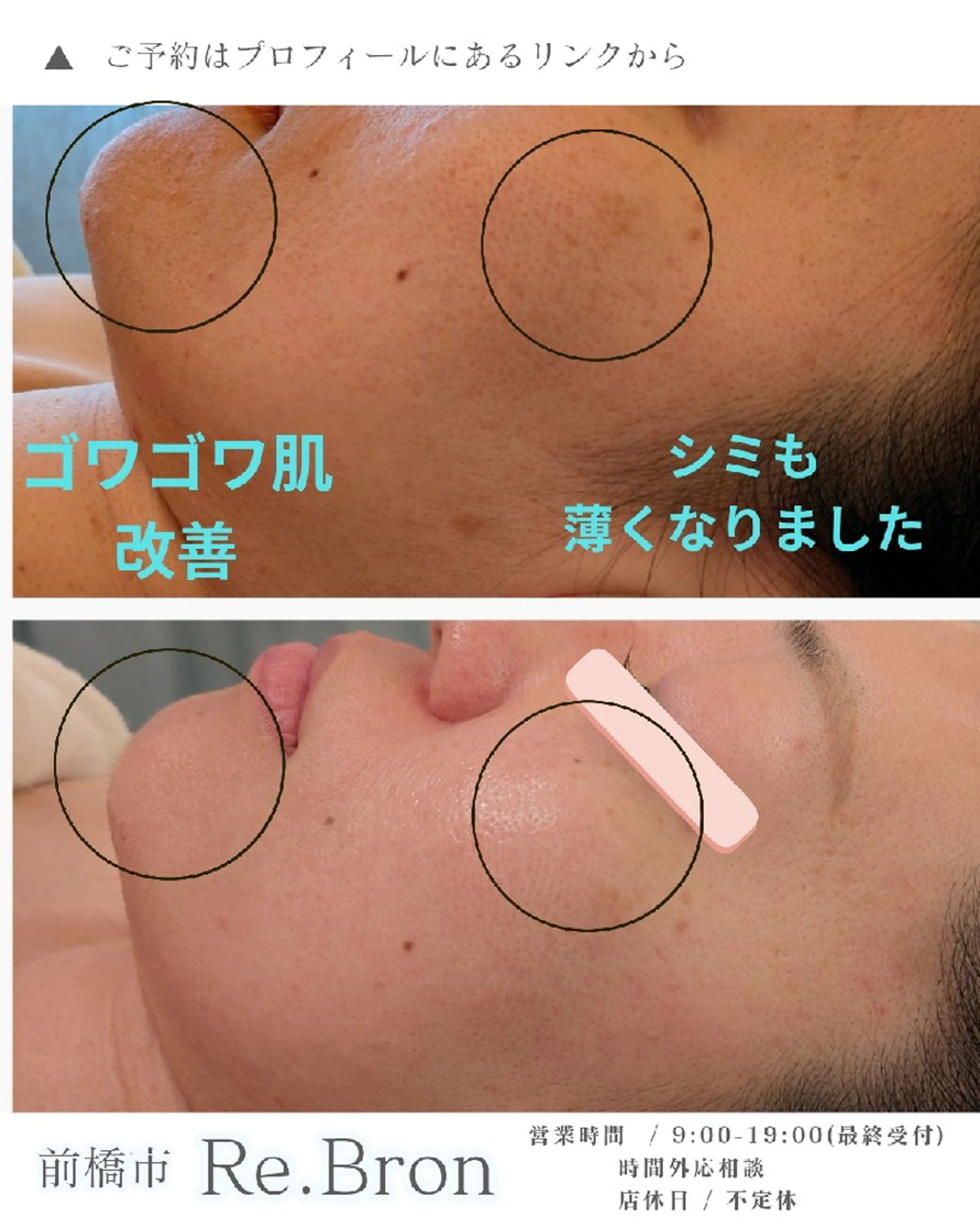 剥離あり／韓国ハーブピーリング｜シミ・くすみ・たるみ・ニキビ肌✨韓国メディカルブランド使用￥16800→円13800の写真