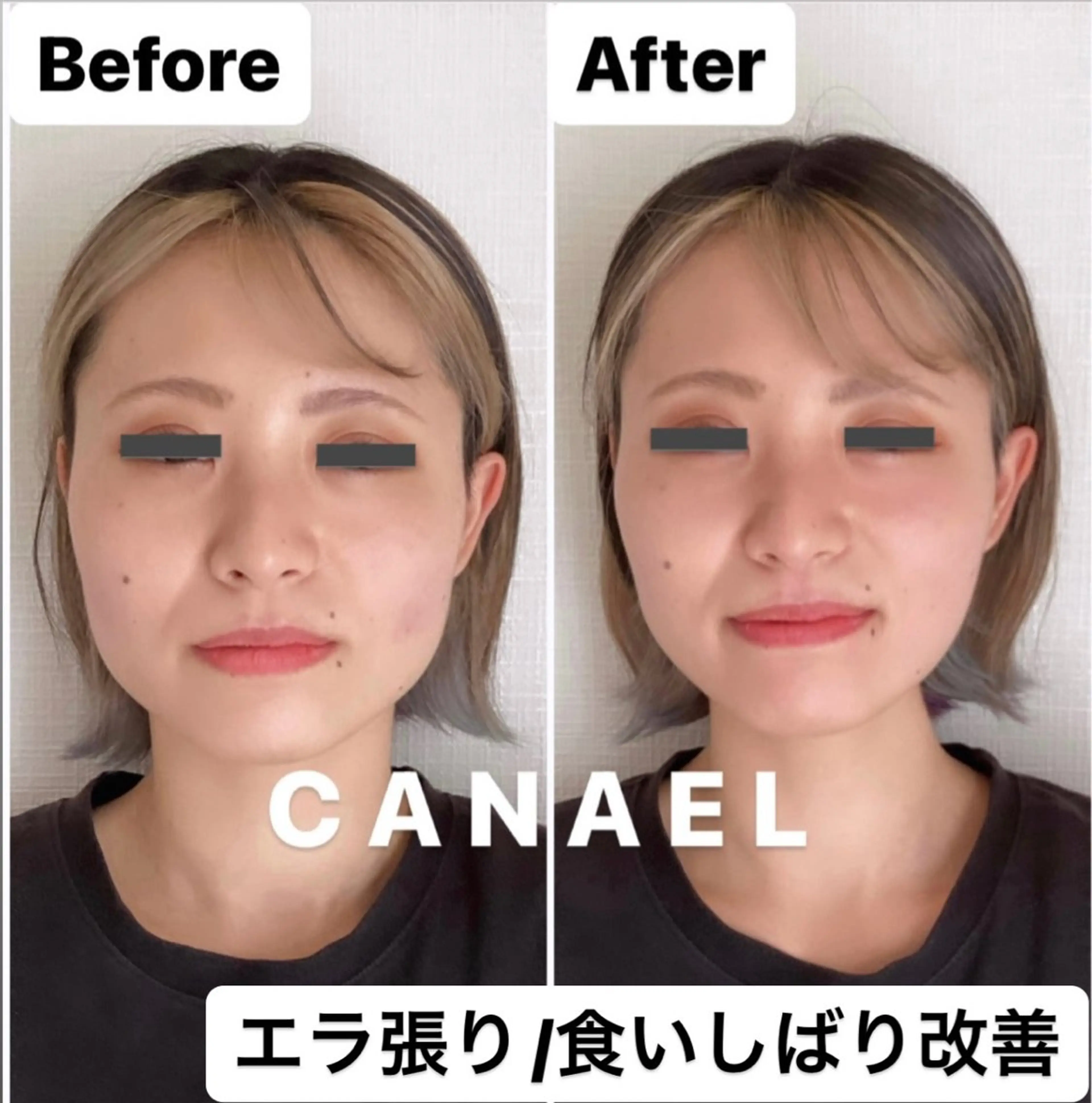 【頭蓋骨/小顔矯正】顔が四角い/エラ張り/食いしばりコースの写真