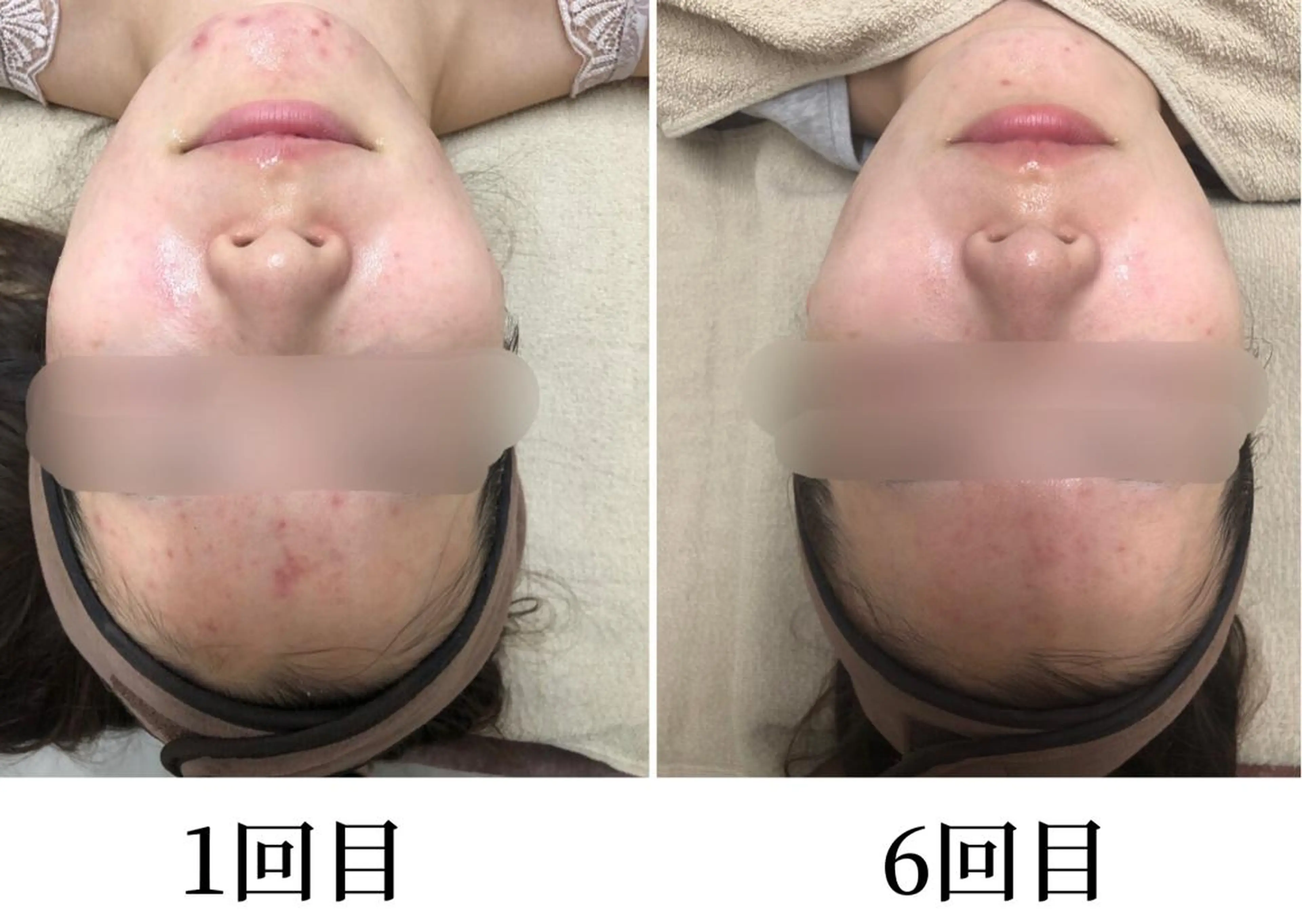 毎月10名様限定‼️プラズマシャワー＋肌別アンプル導入【ニキビ/毛穴開き】¥14000→¥8,500の写真