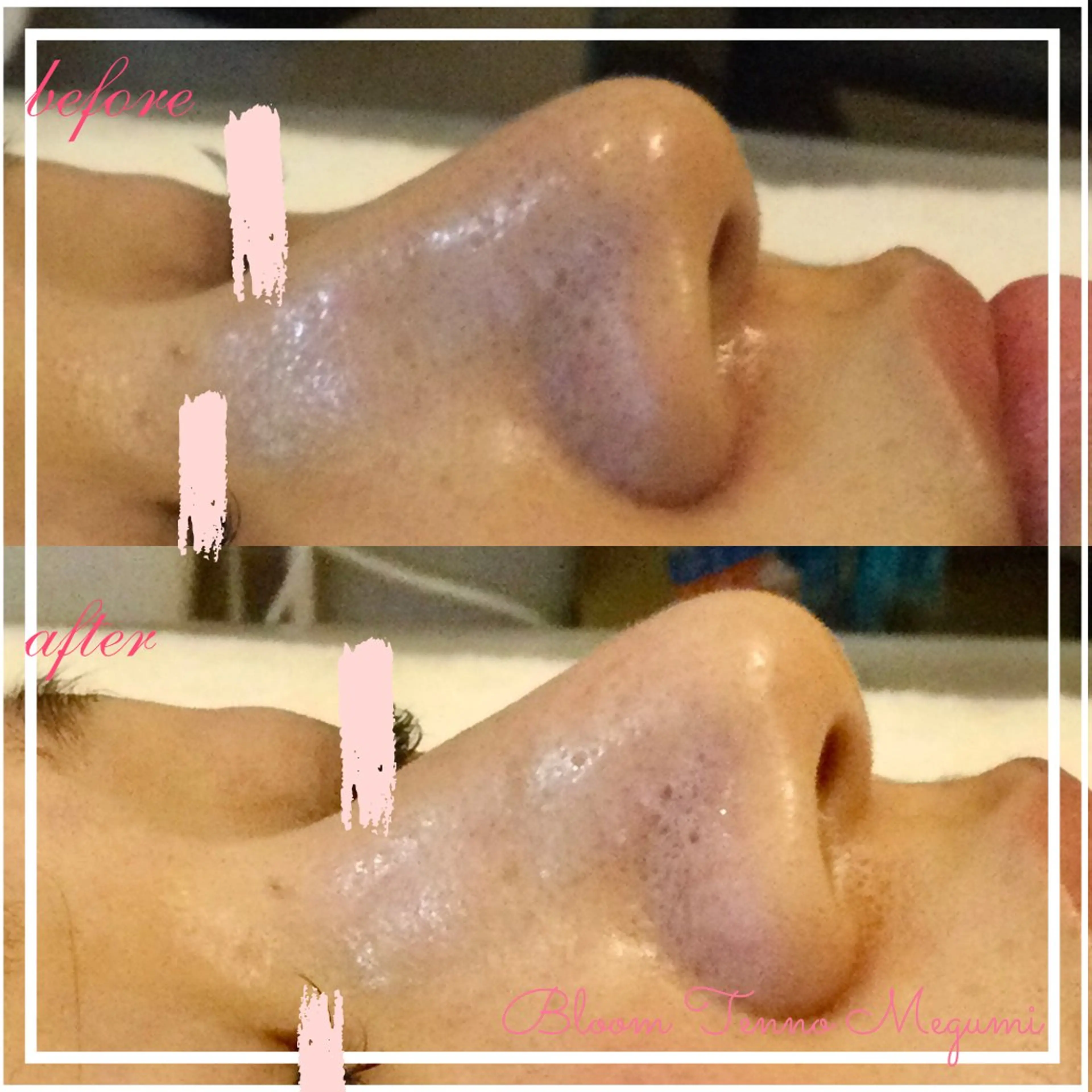 毛穴レスコース　　70分✨🆕メニューキャンペーン✨の写真