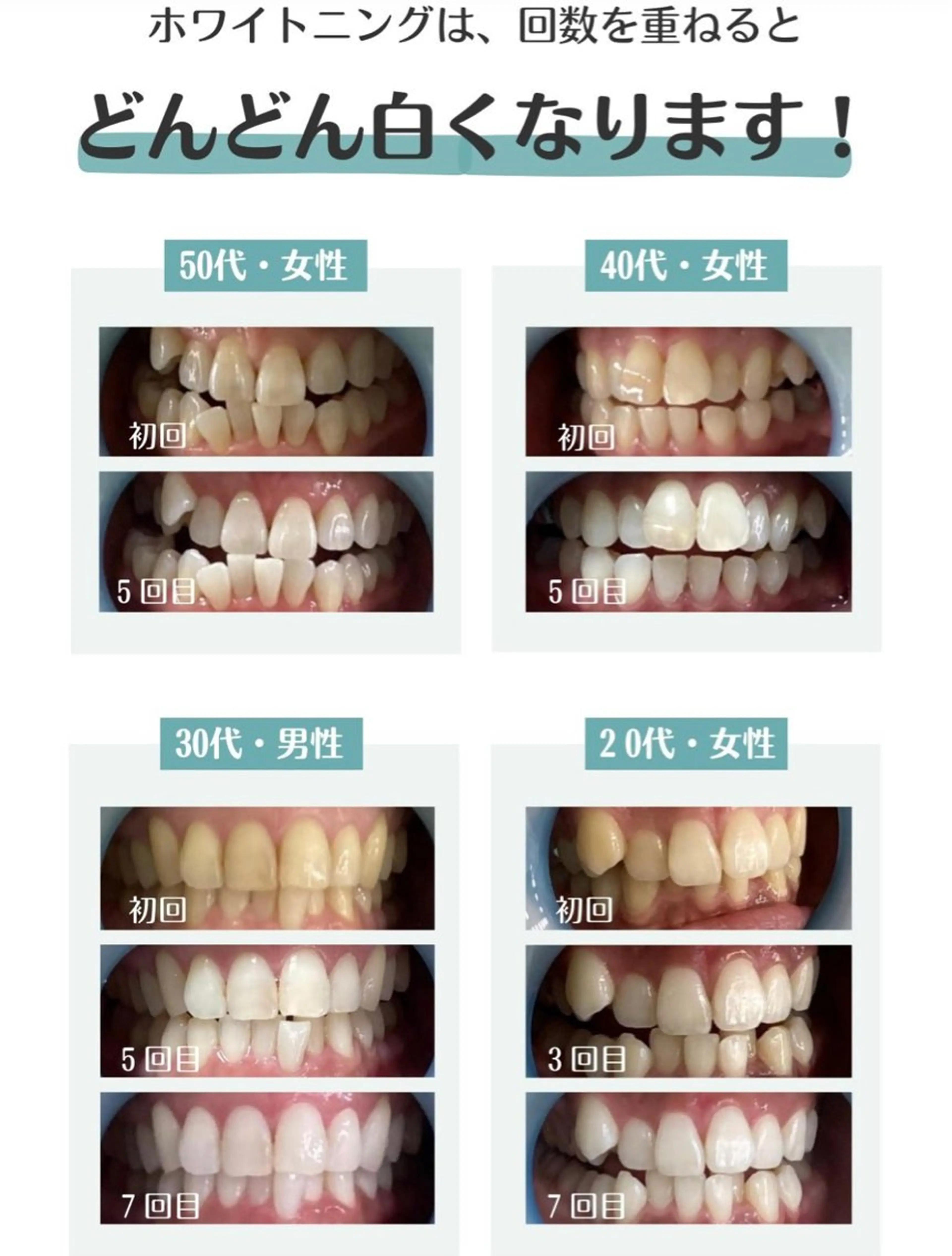 【ミニモ限定】メディアで話題♪セルフホワイトニング✨プレミアムコース✨8分x2【すぐ予約対象外】の写真