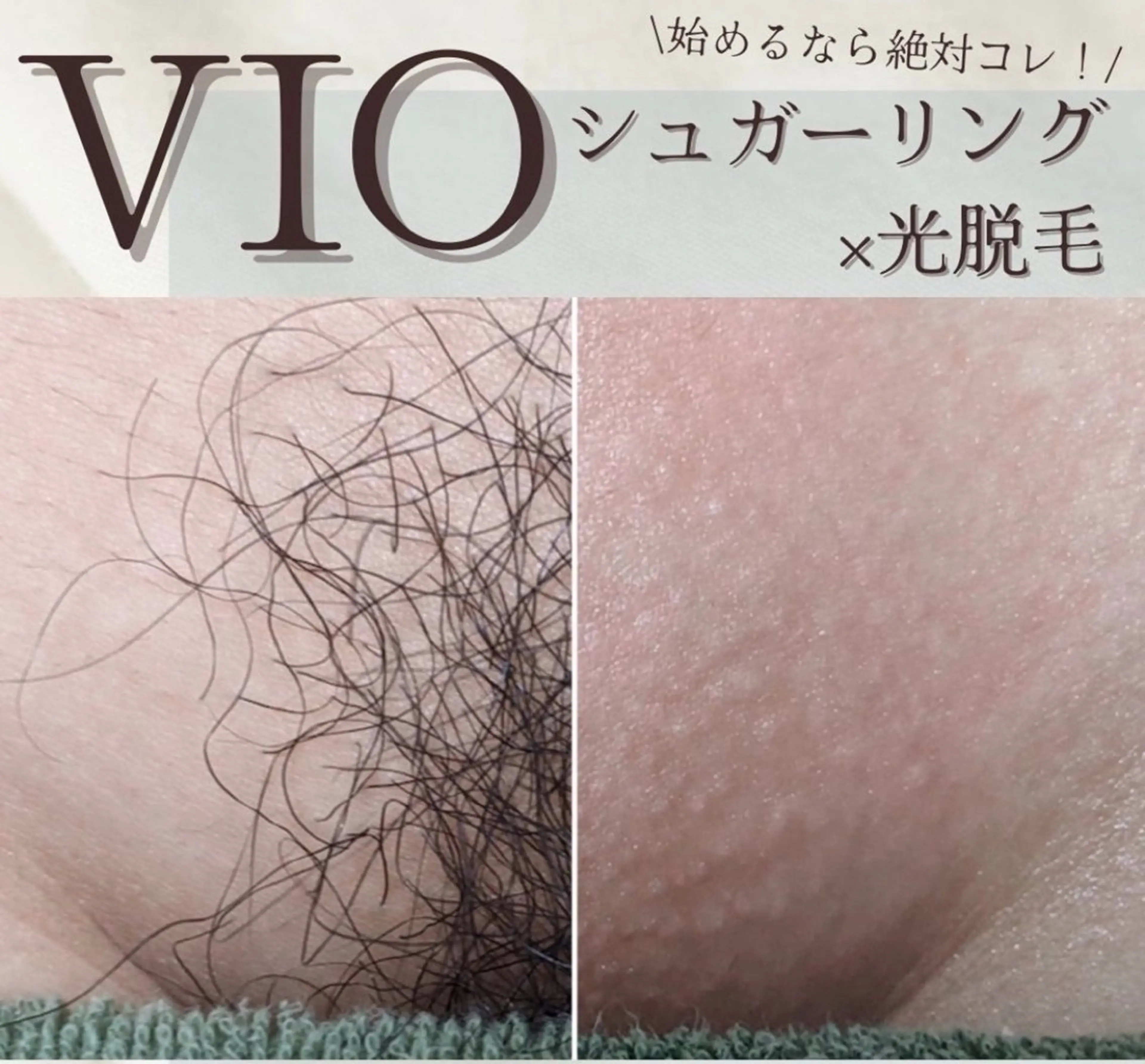人気Ｎｏ.1✨【VIO シュガーリング🍯+最新式光脱毛✨】で当日からつるつる！チクチクしないVIOmix脱毛🍯💕の写真