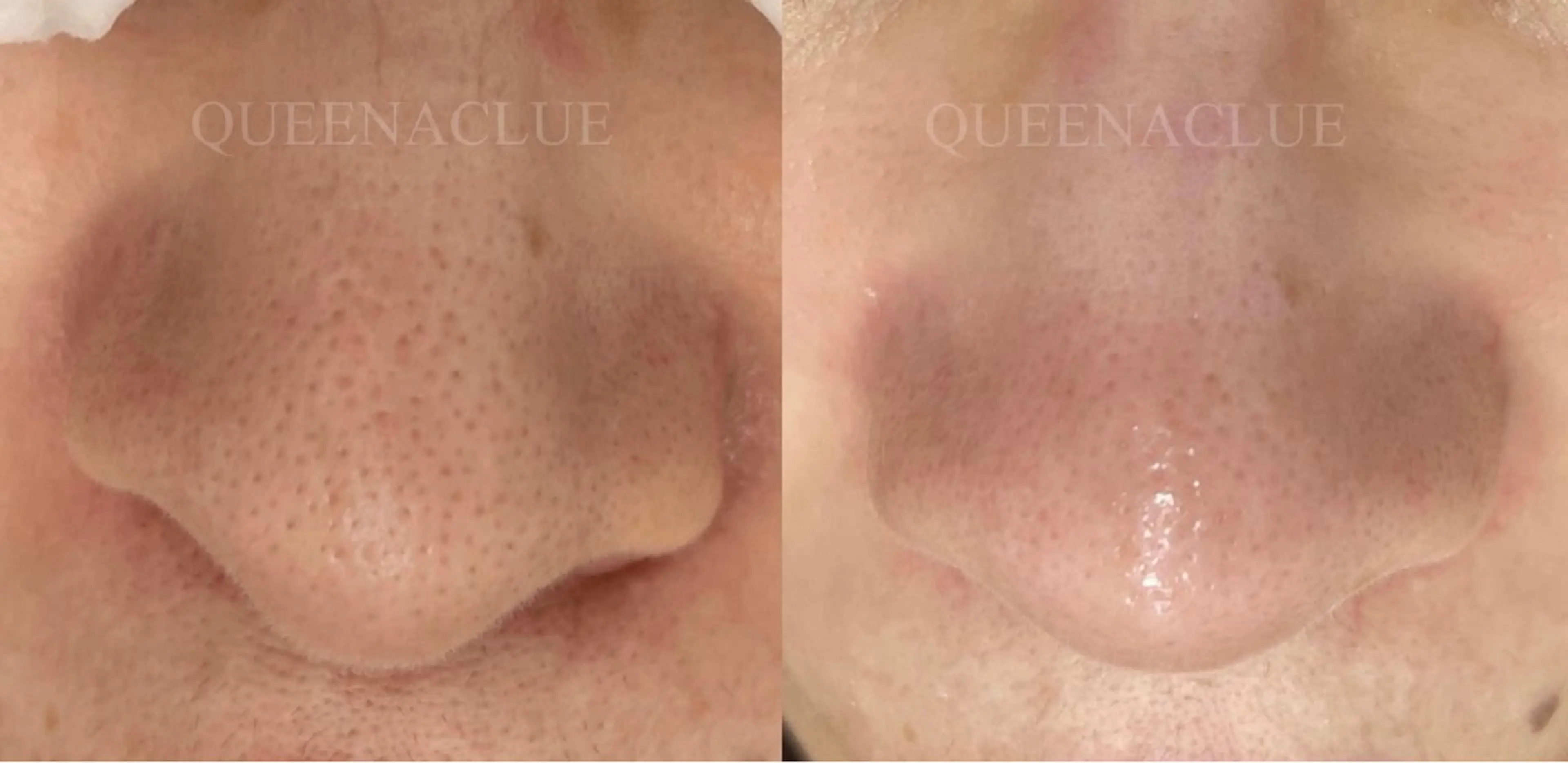 毛穴改善/脱毛 ネイル　川上久仁子のエステ・リラクイメージ