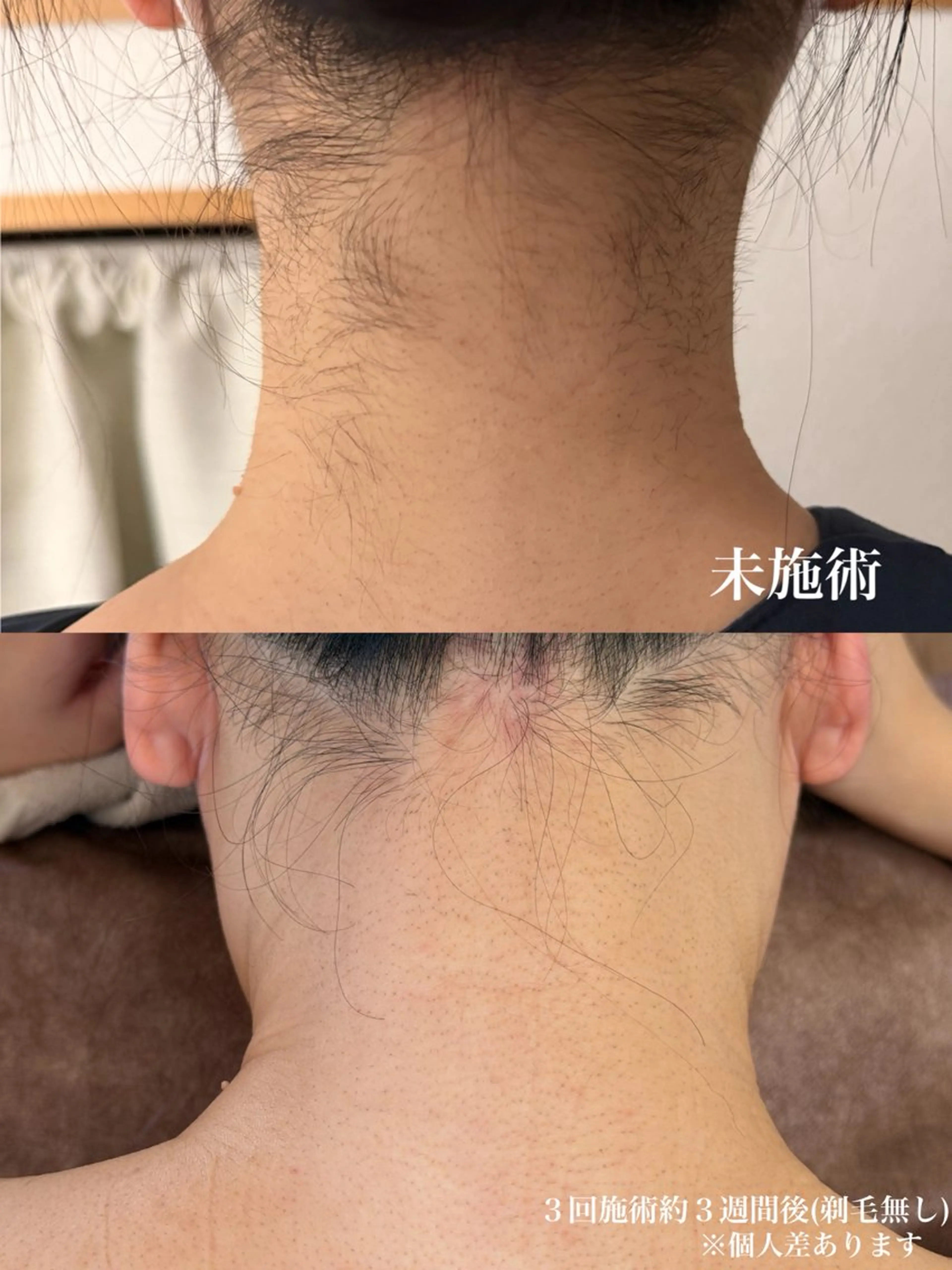 レディースうなじ脱毛の写真