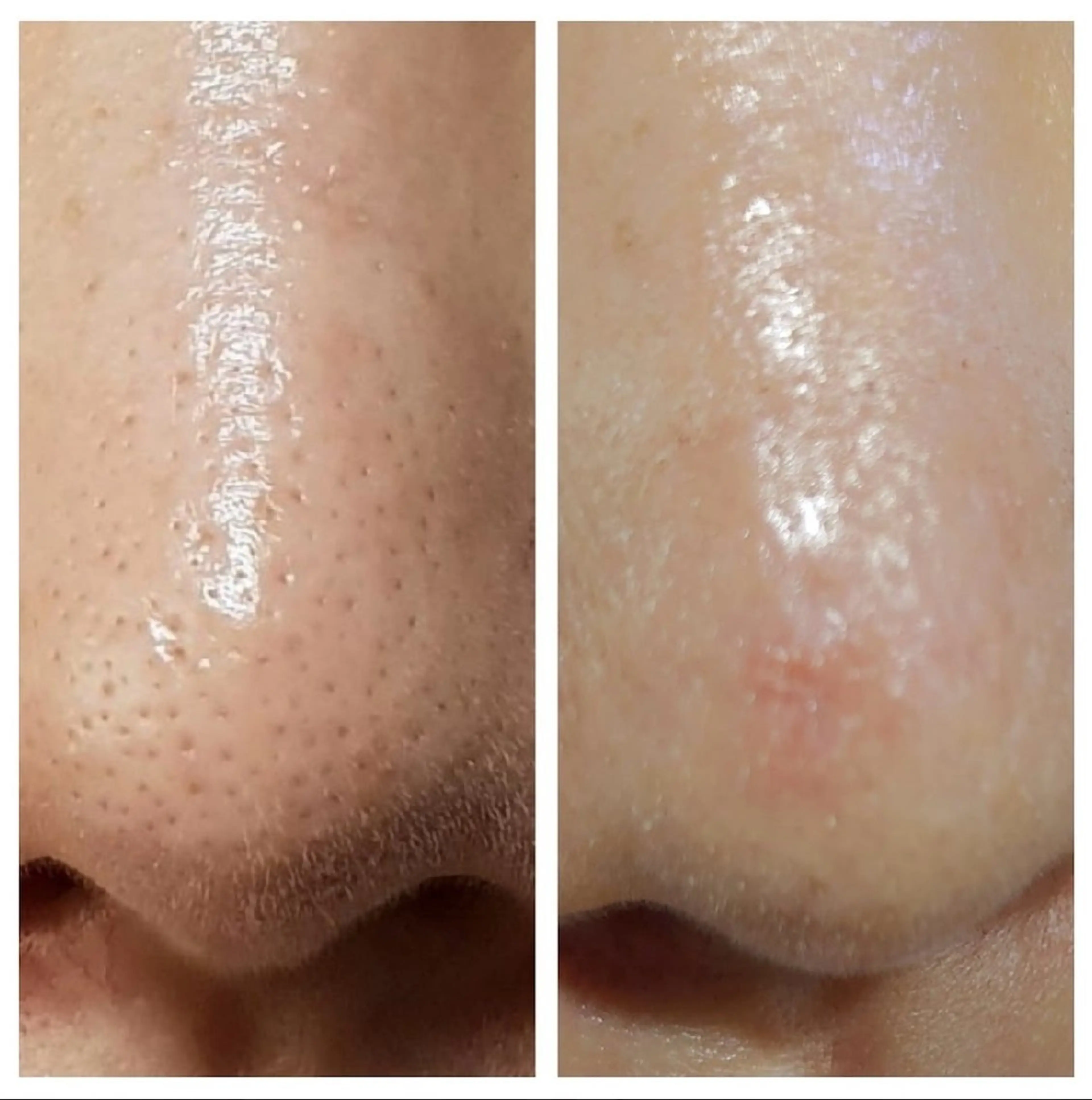 肌管理ピーリング脱毛 よもぎ/日暮里Ⓜ︎のエステ・リラクイメージ