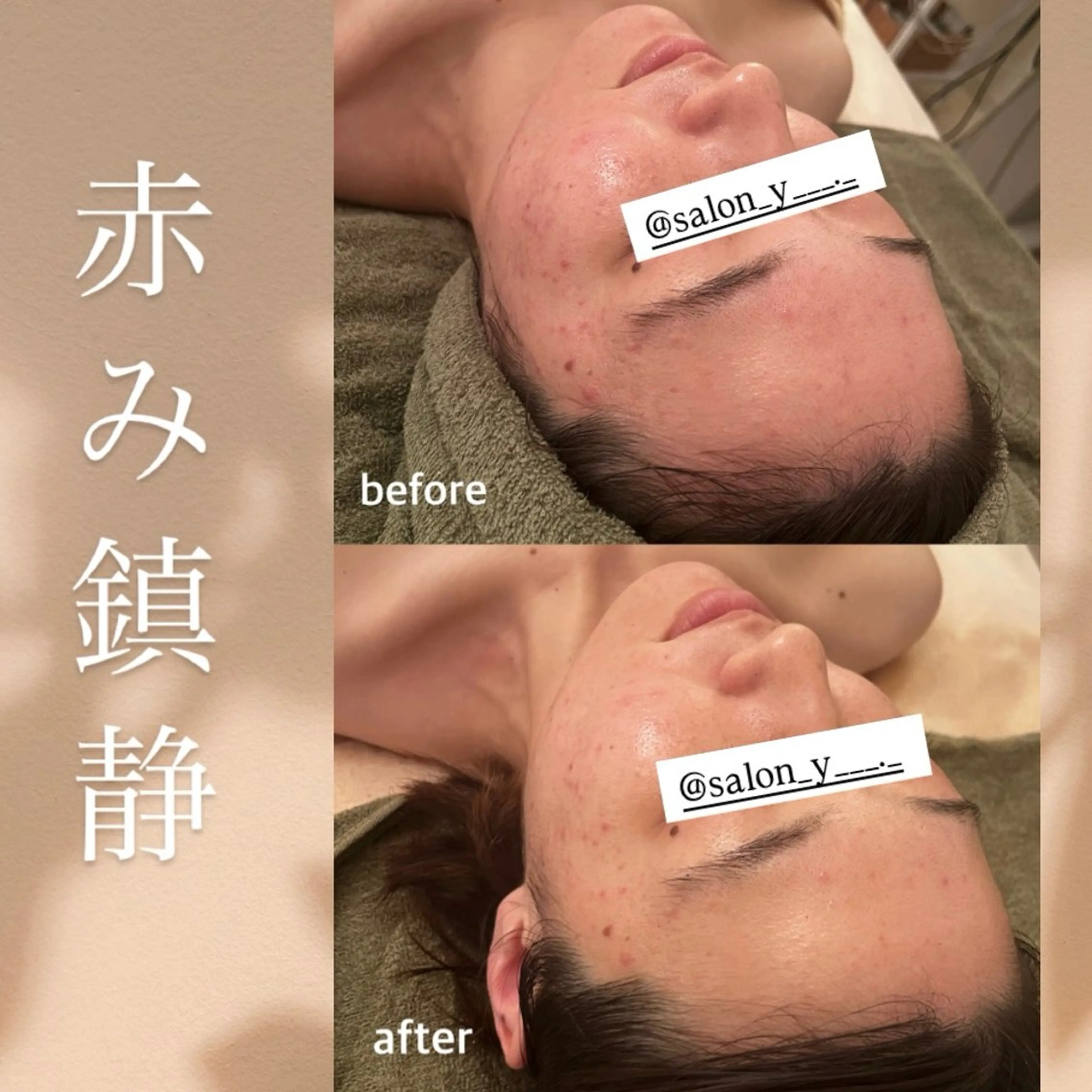 エステ コルギ✖︎ピーリング y ANESISのエステ・リラクイメージ