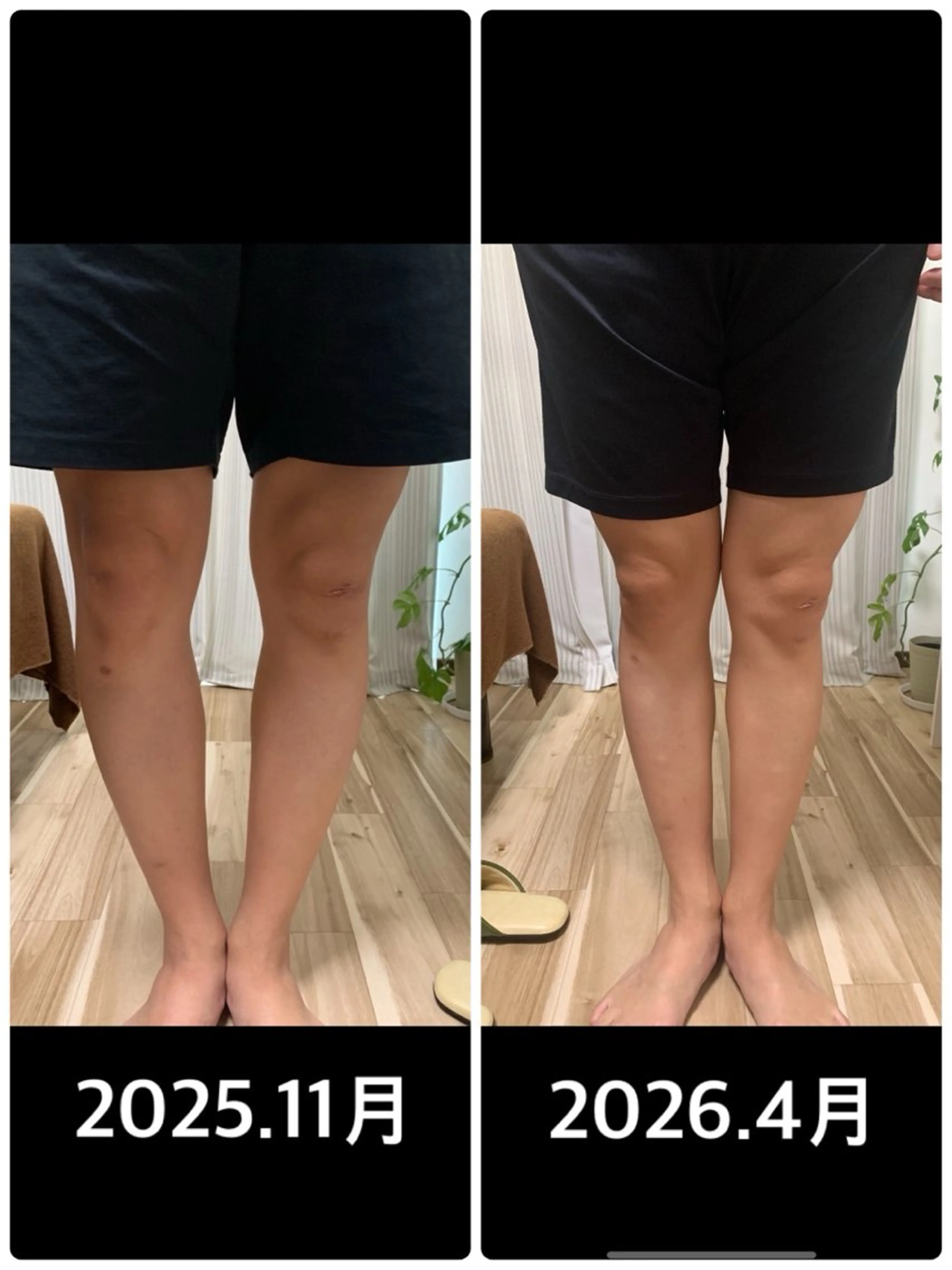 骨盤矯正、O脚矯正の写真