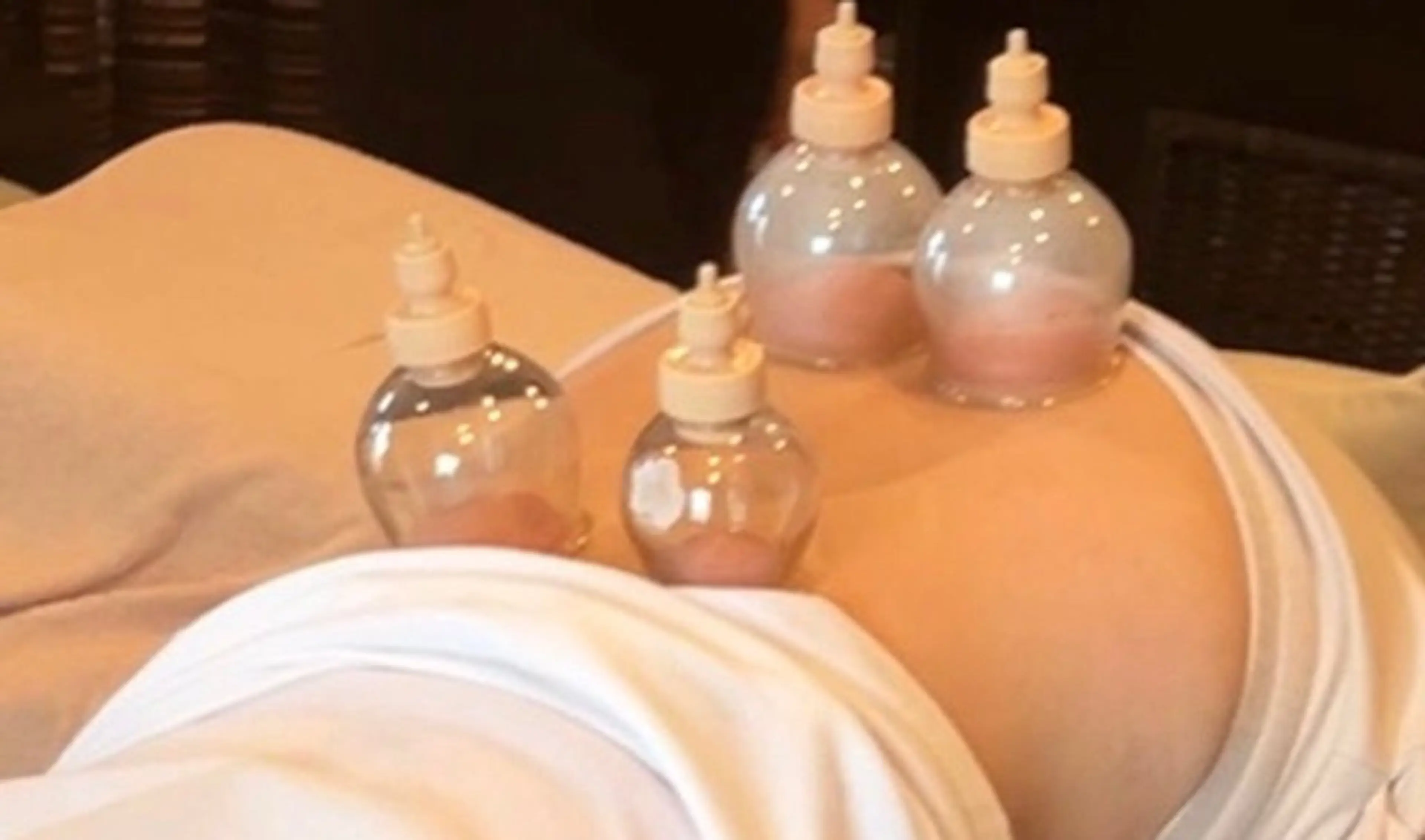 ミニモ限定メニュー❣️🌈トップアスリートからハリウッド女優にも人気のカッピング療法(吸い玉)🎶🌈の写真