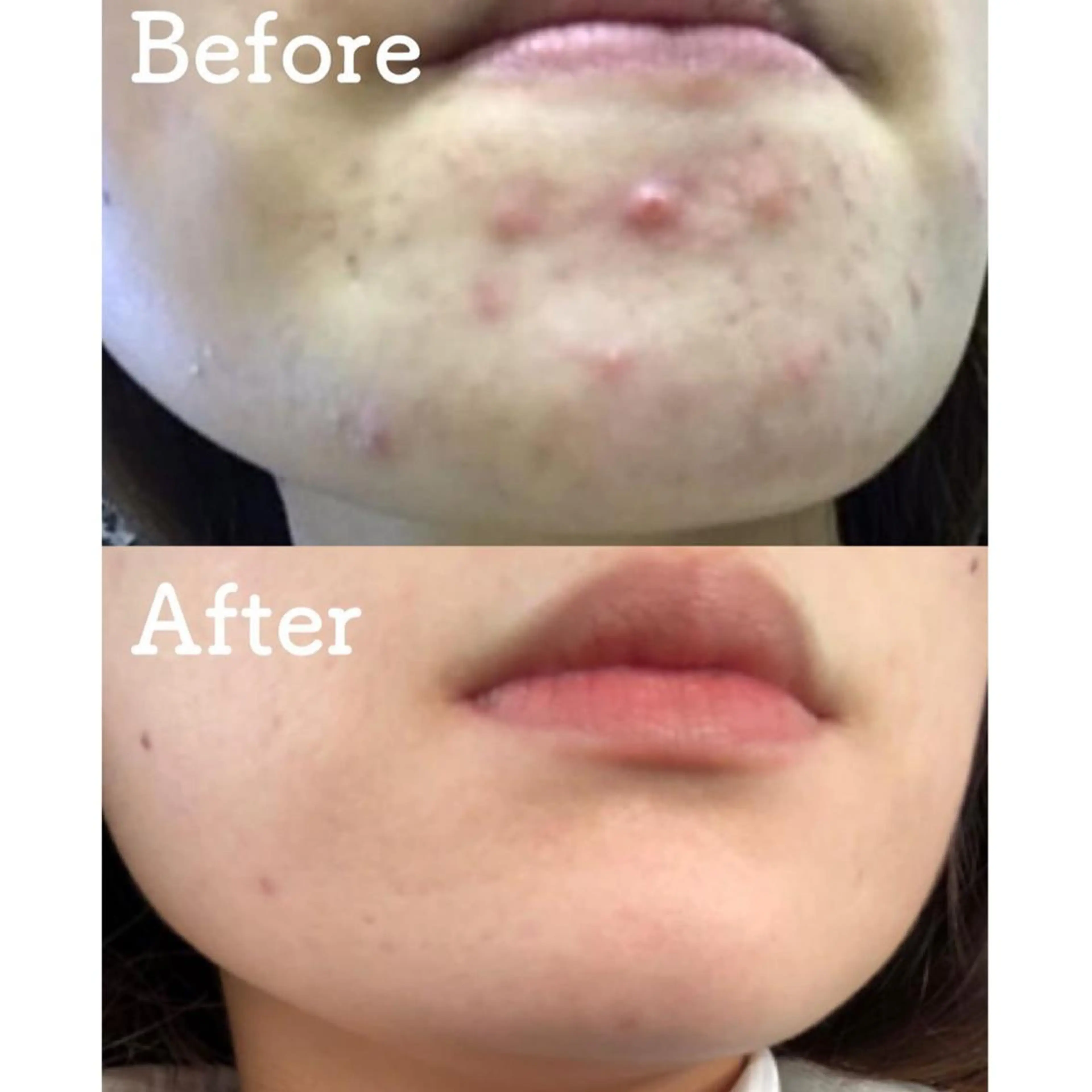 全国からご予約殺到✨ニキビやニキビ跡にお悩みの方に◎フェイシャル体験コース💆🏻♀️の写真