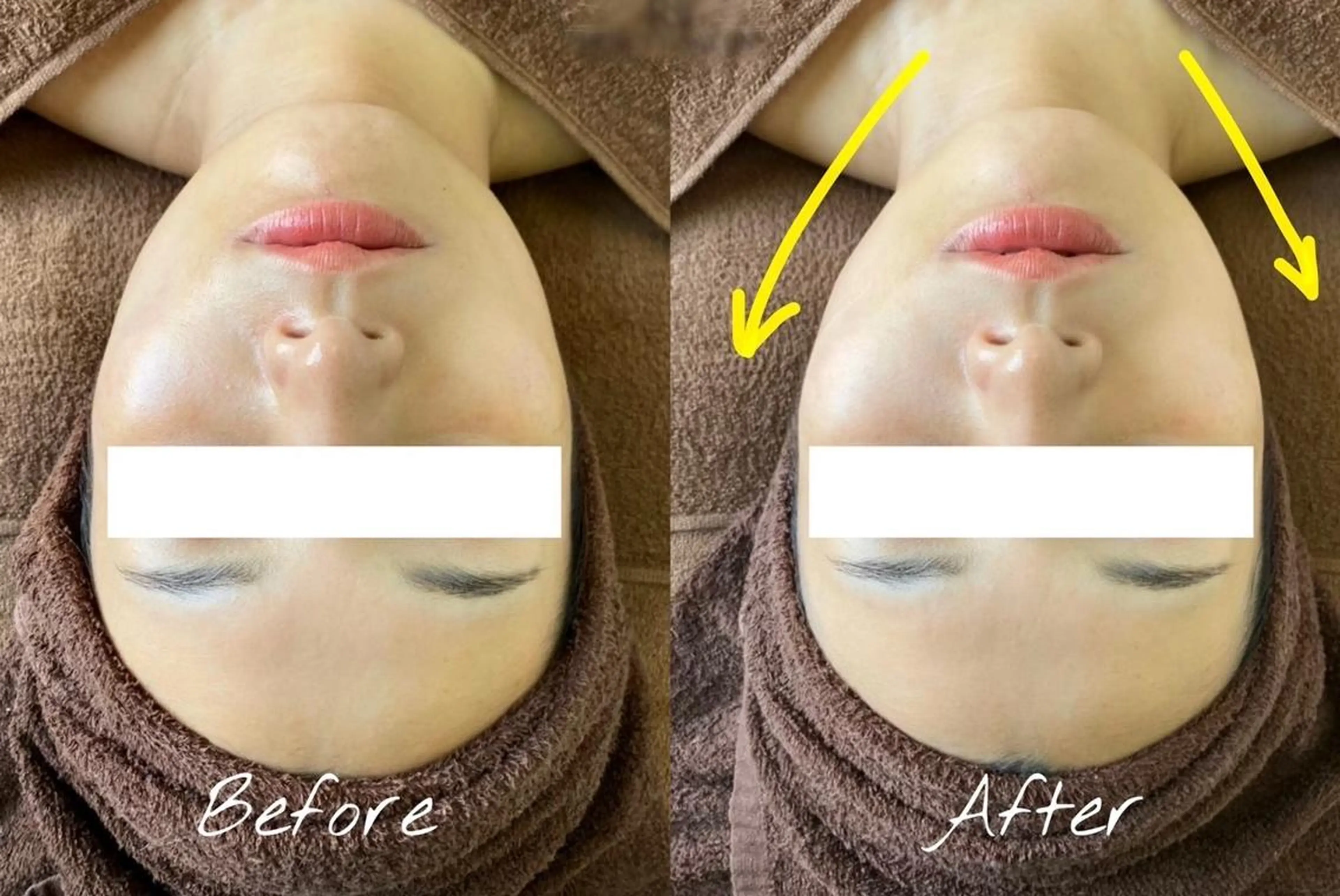 【瞬間リフトアップ‼】サーマルフラクショナル（サーマクール）【小顔・引締めならこれ一択🔥】の写真