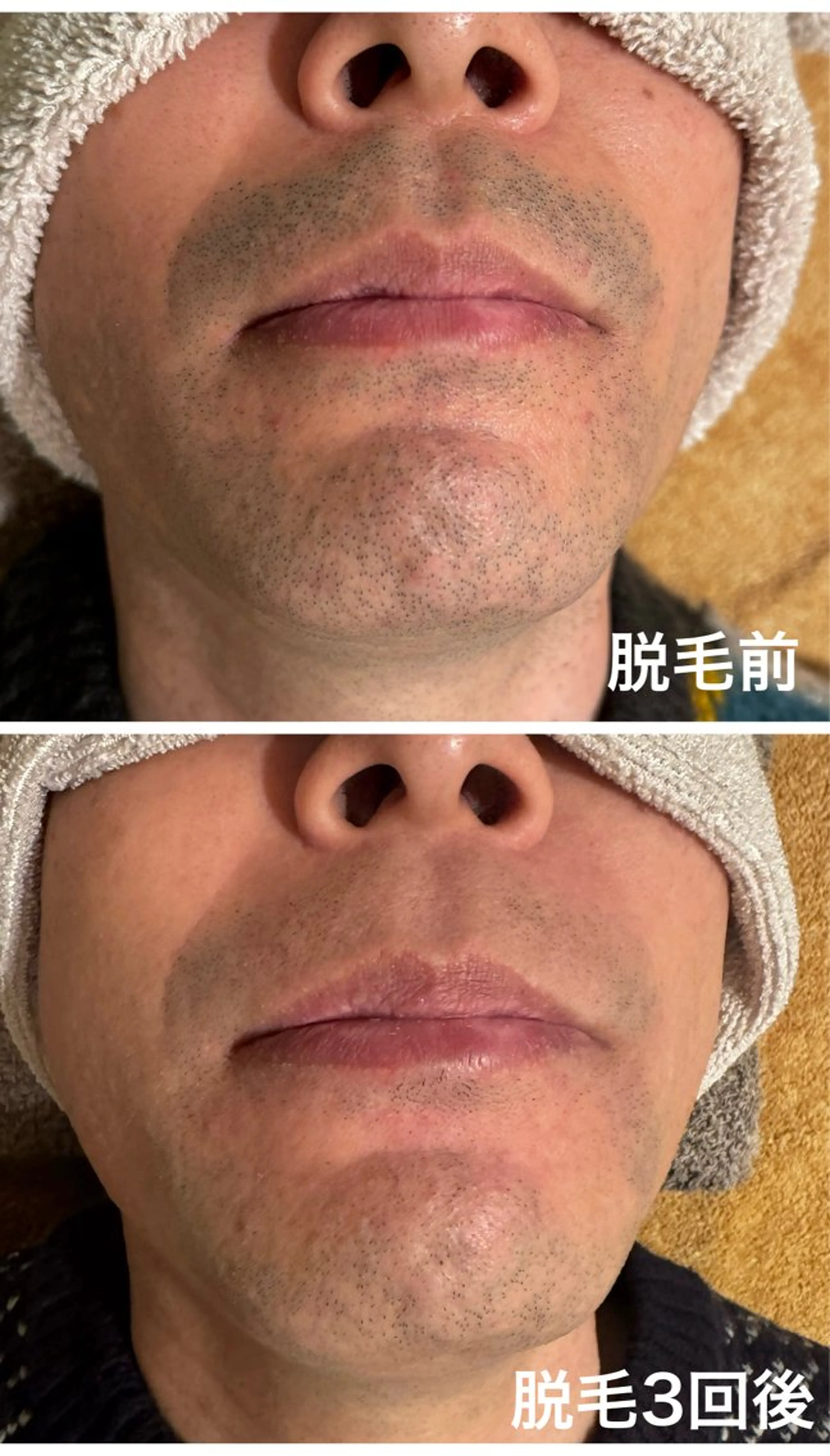 ひげ脱毛おまかせ下さい！ひげ脱毛1回体験☆の写真