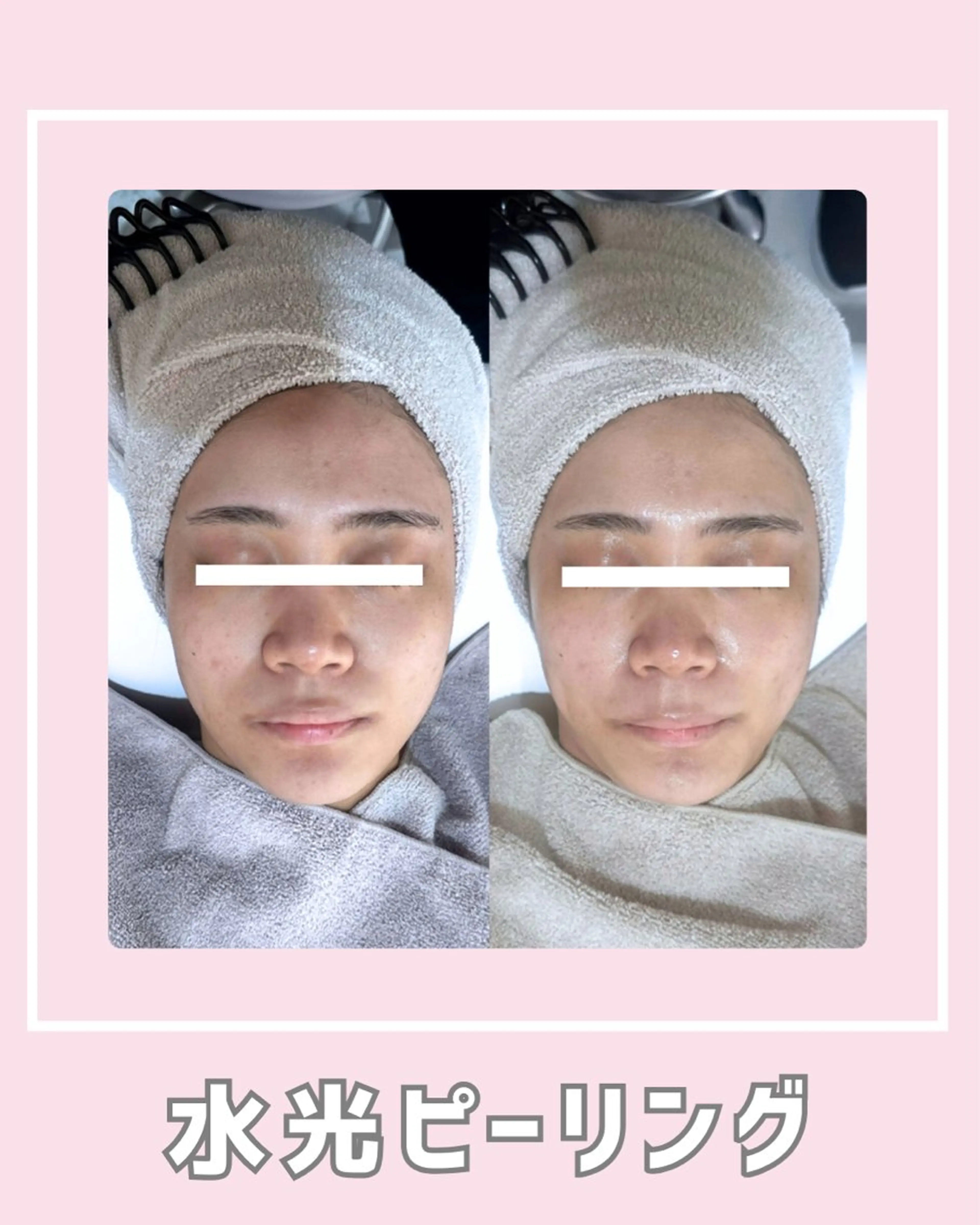 エステ |ピーリング・毛穴| soina神楽坂のエステ・リラクイメージ