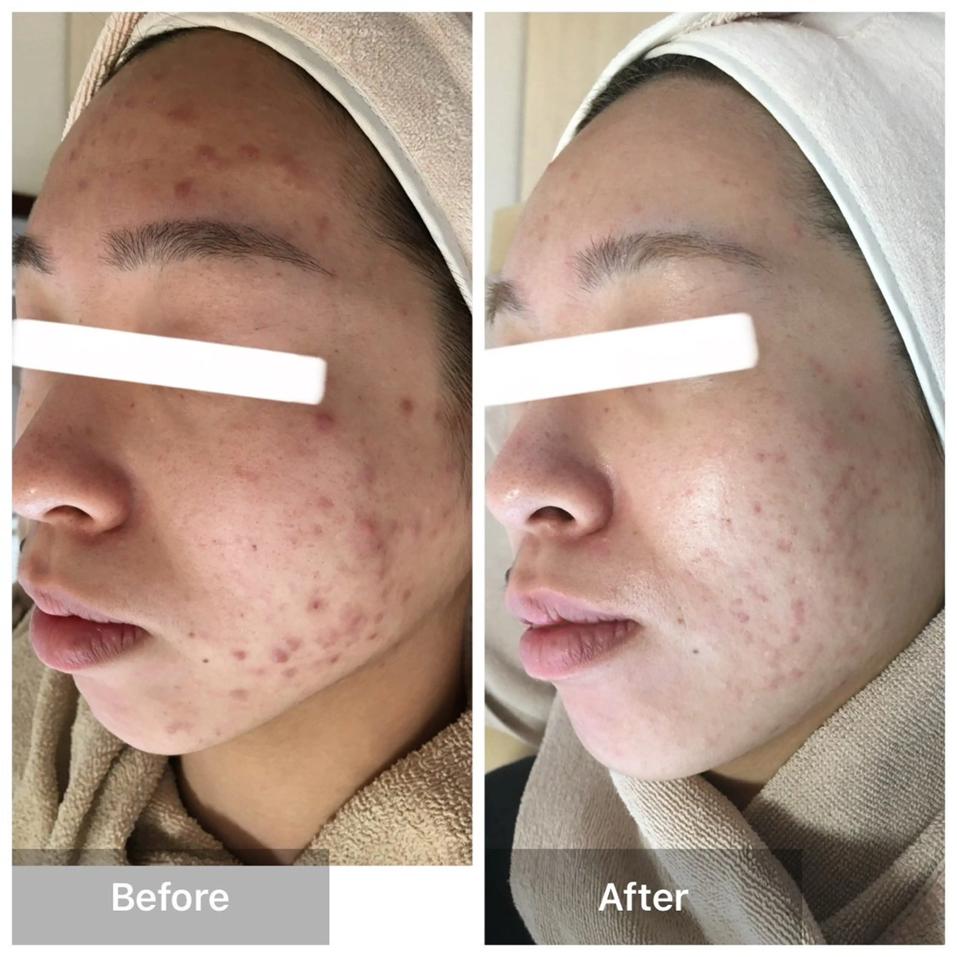 🌿毛穴特化ハーブピーリング✨【剥離あり】【ノーズクレンジング】ニキビ/ニキビ跡/黒ずみ/水光肌/毛穴ケア/毛穴の黒ずみの写真