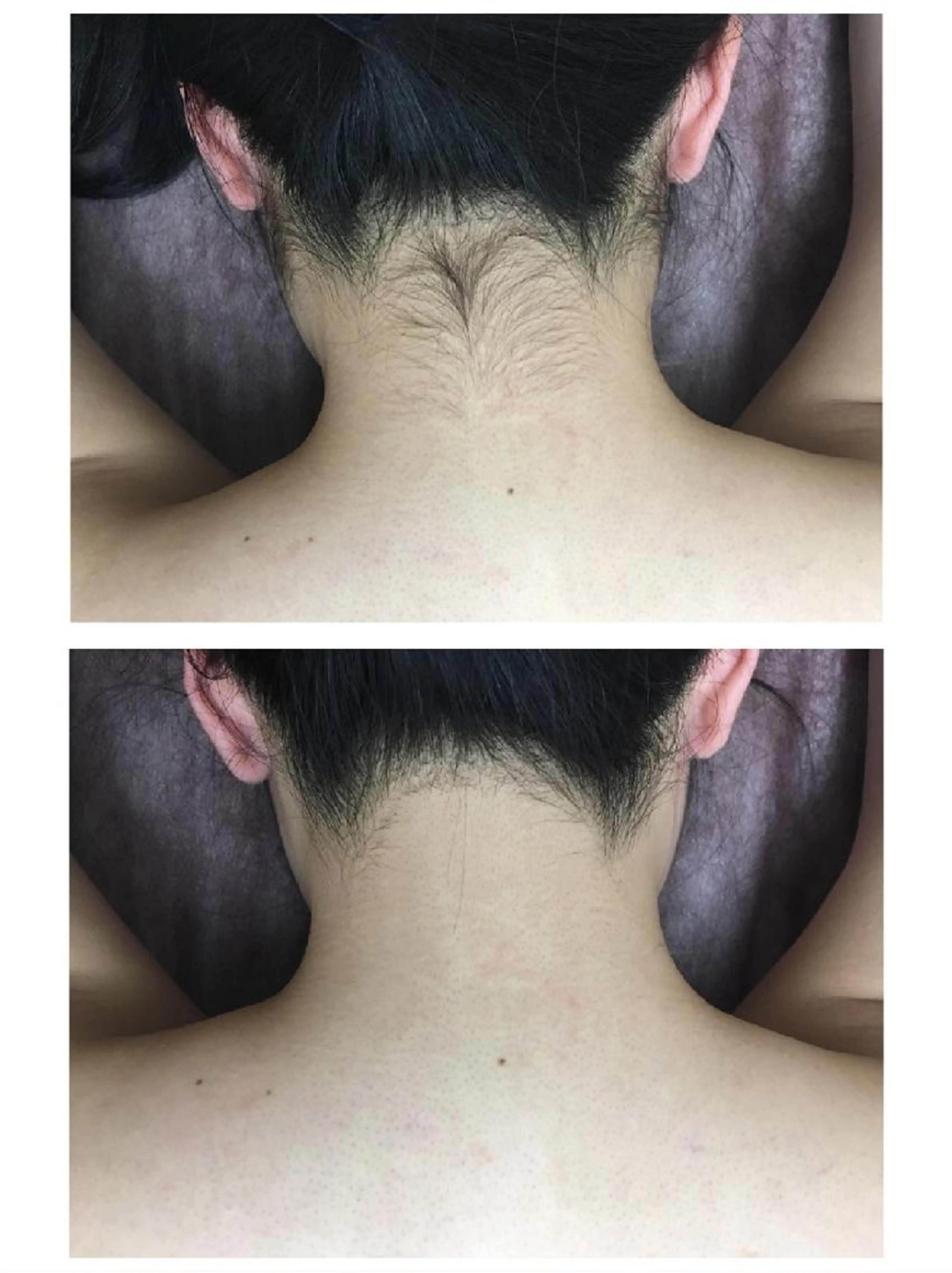 【うなじ】🔰脱毛モニター募集中🔰3回3,900円💙Primaの人気部位💙イベント前にも☺️の写真