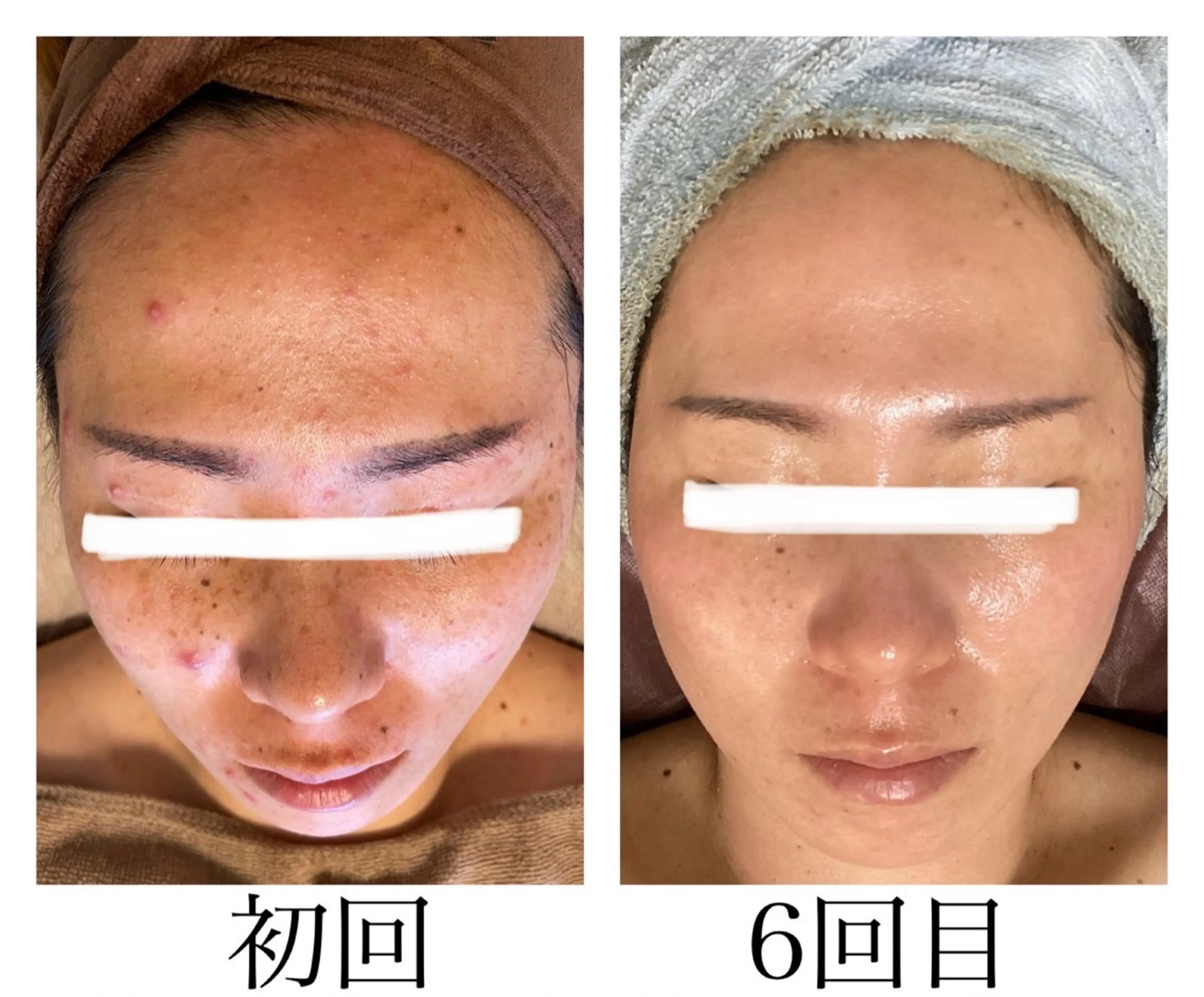 【温活デトックス×肌再生】剥離なし！REVIハーブピーリングとよもぎ蒸しセット🌿✨の写真