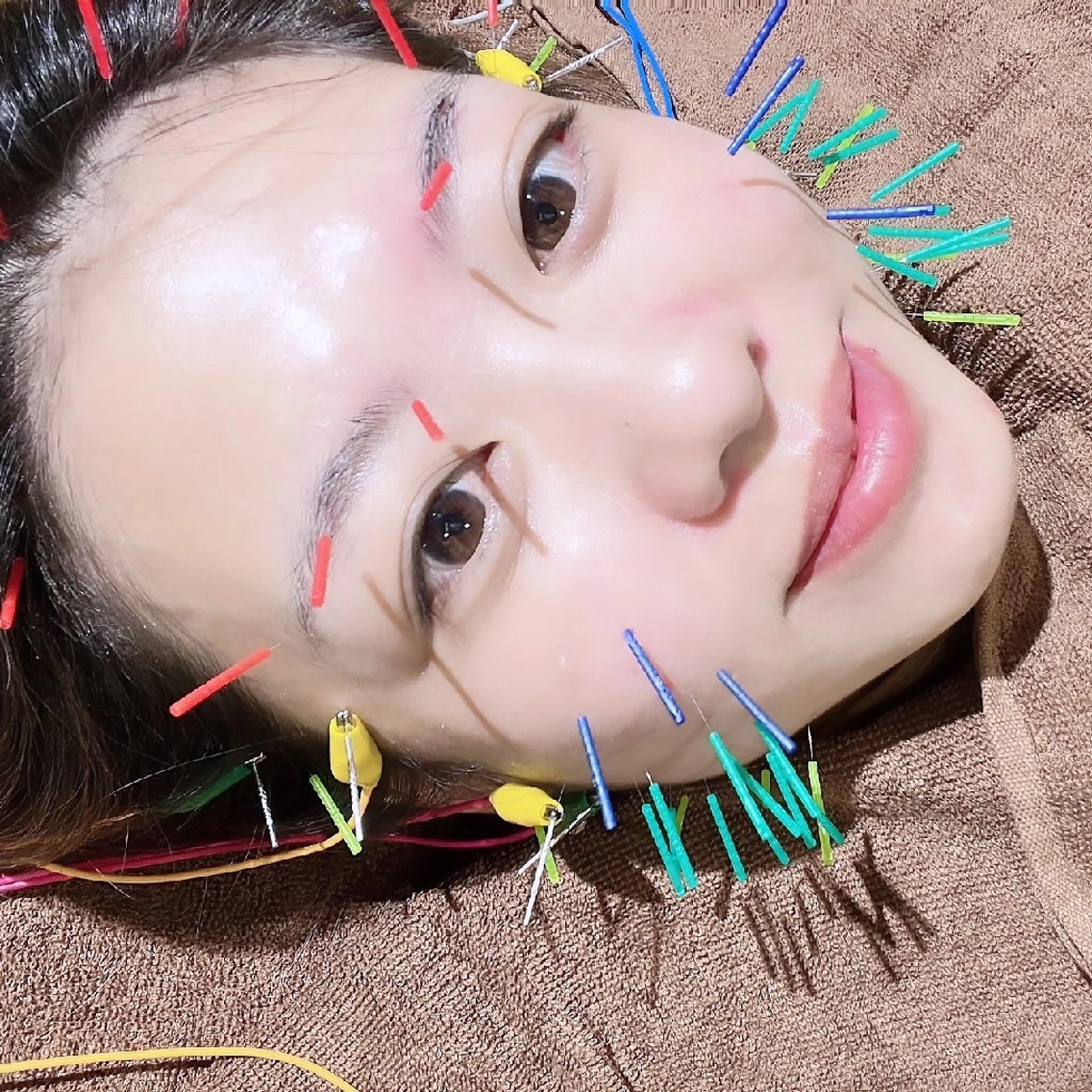 ⚠️期間限定[💥腰痛、痺れに]🌈全身美容鍼(うつ伏&仰向)＋パルス＋マッサージ　90分の写真