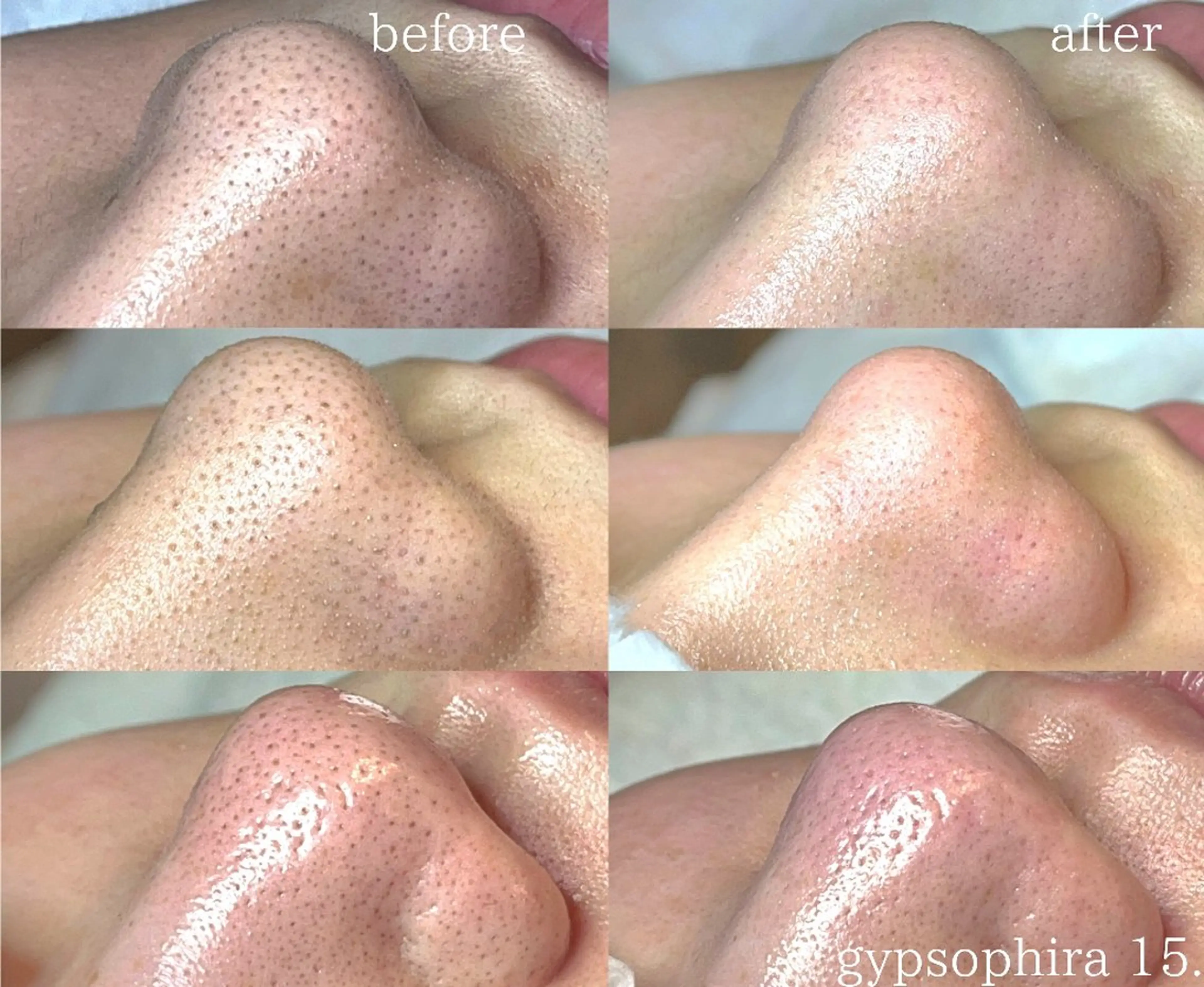 毛穴ハーブピーリング gypsophiraのエステ・リラクイメージ