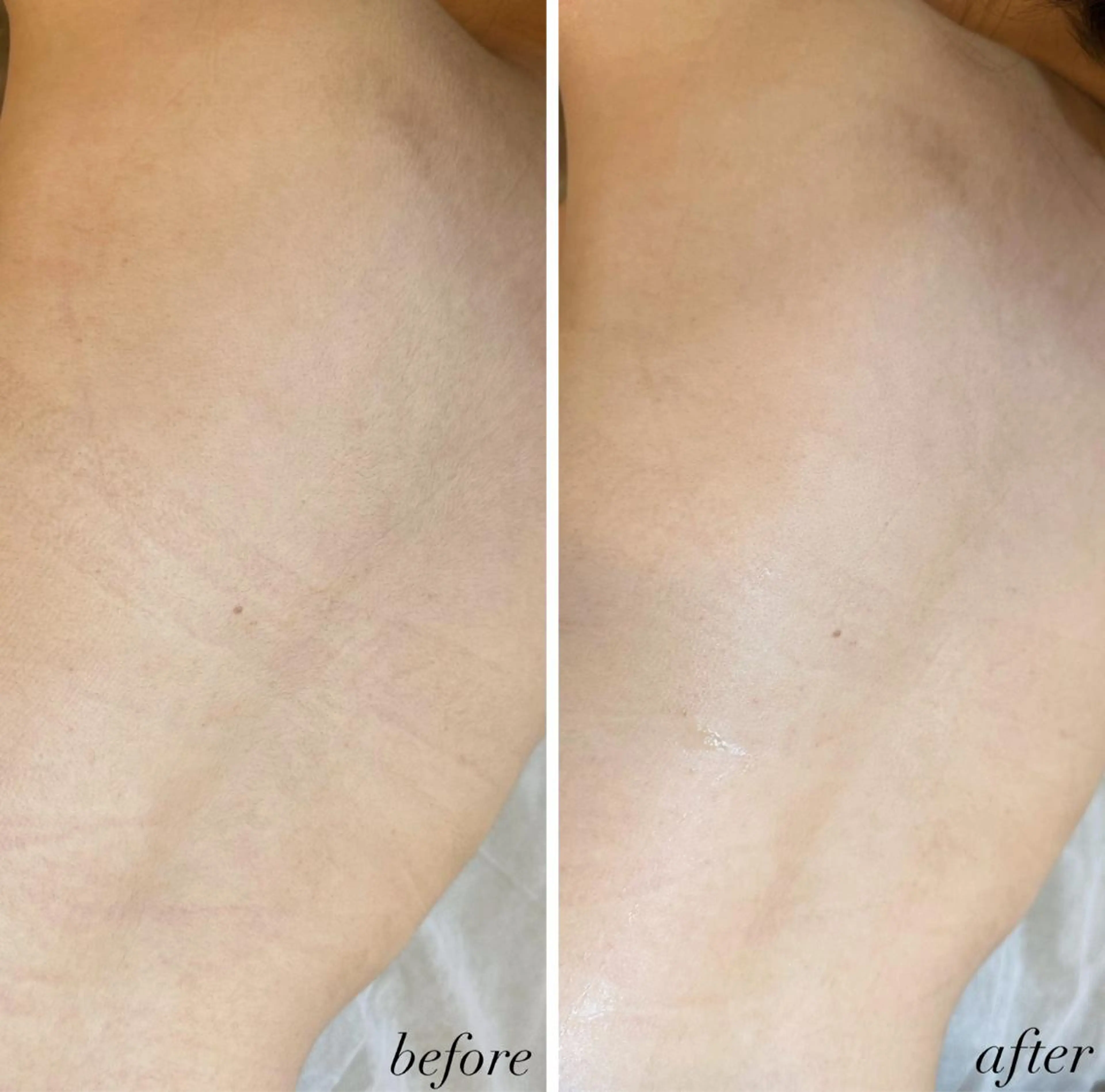 脱毛 うなじ脱毛/美肌脱毛 LABELのエステ・リラクイメージ