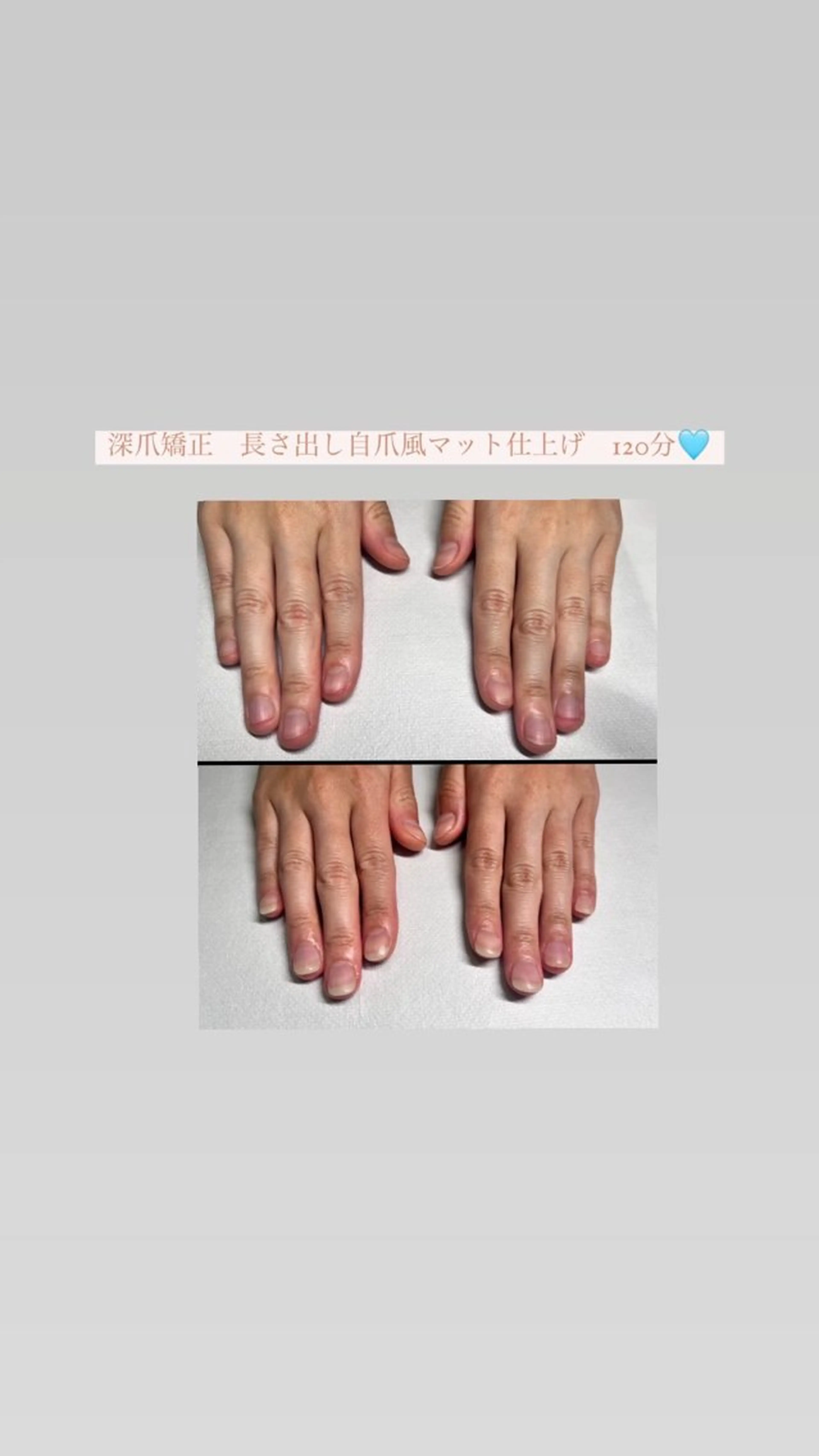 メンズ ネイル 爪ケア/深爪 自爪育成 🐰えむのネイルデザイン