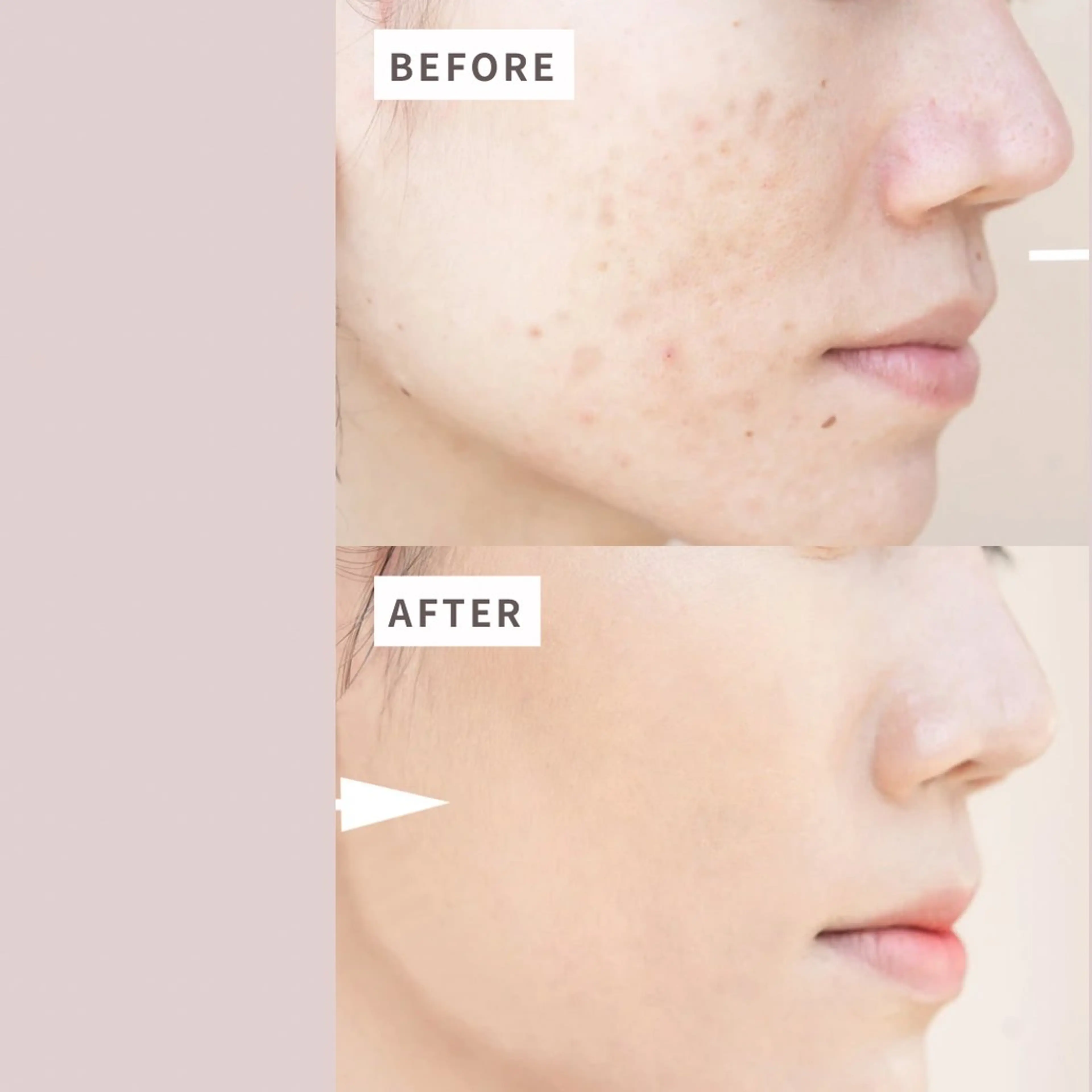 シワたるみ改善！　小顔フェイシャルの写真