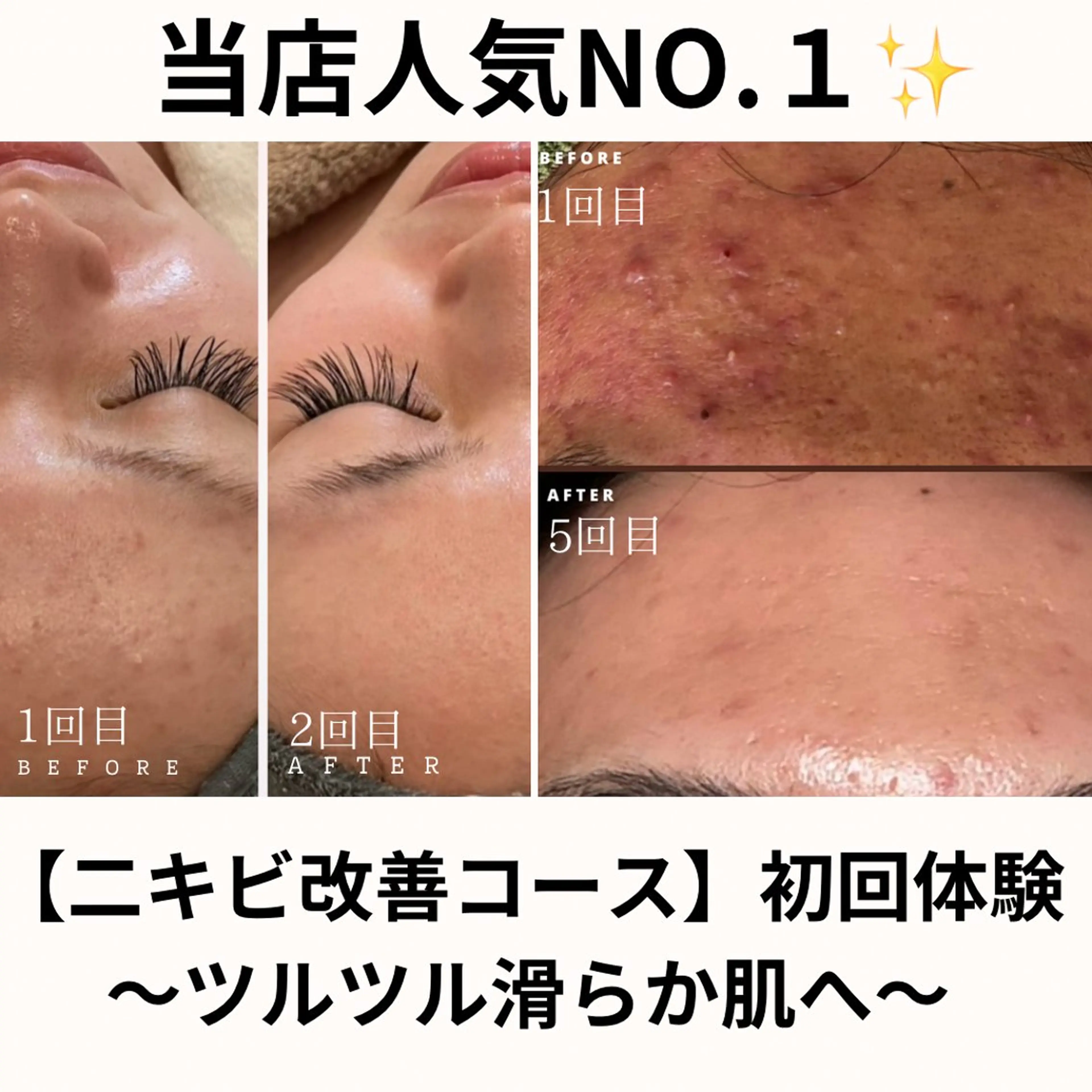 【本気集中】年齢毛穴ケア（剥離あり）通常18,000円の写真