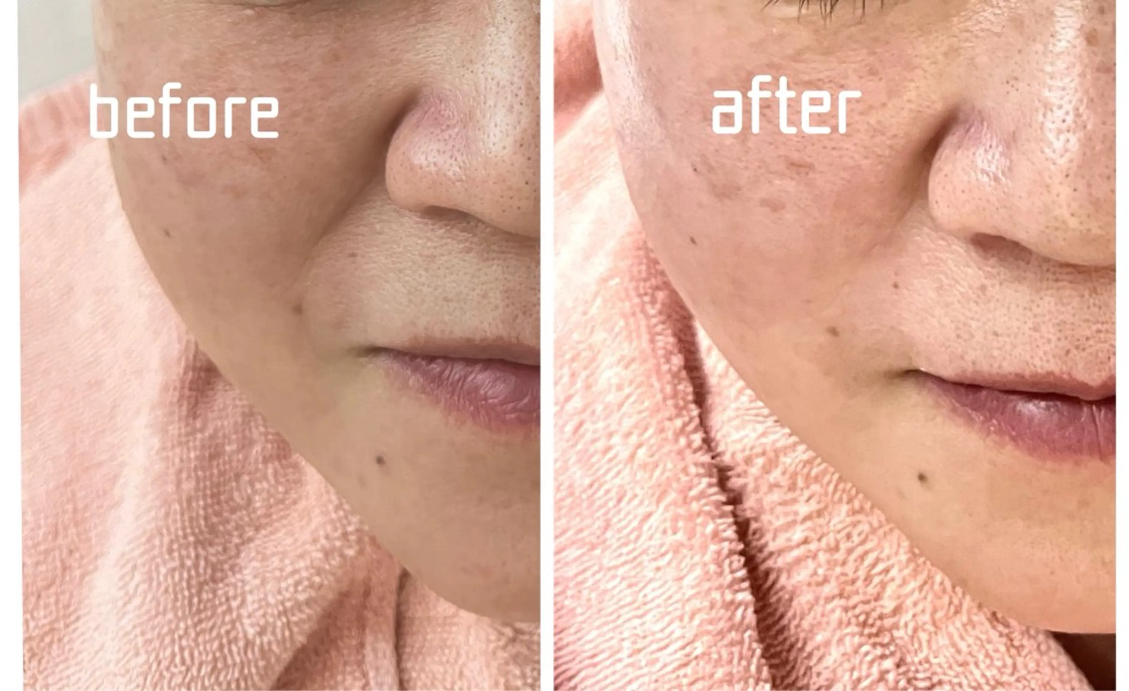 今なら50%off❗️5歳若く見える口元へ｜ほうれい線リフトケア90分の写真