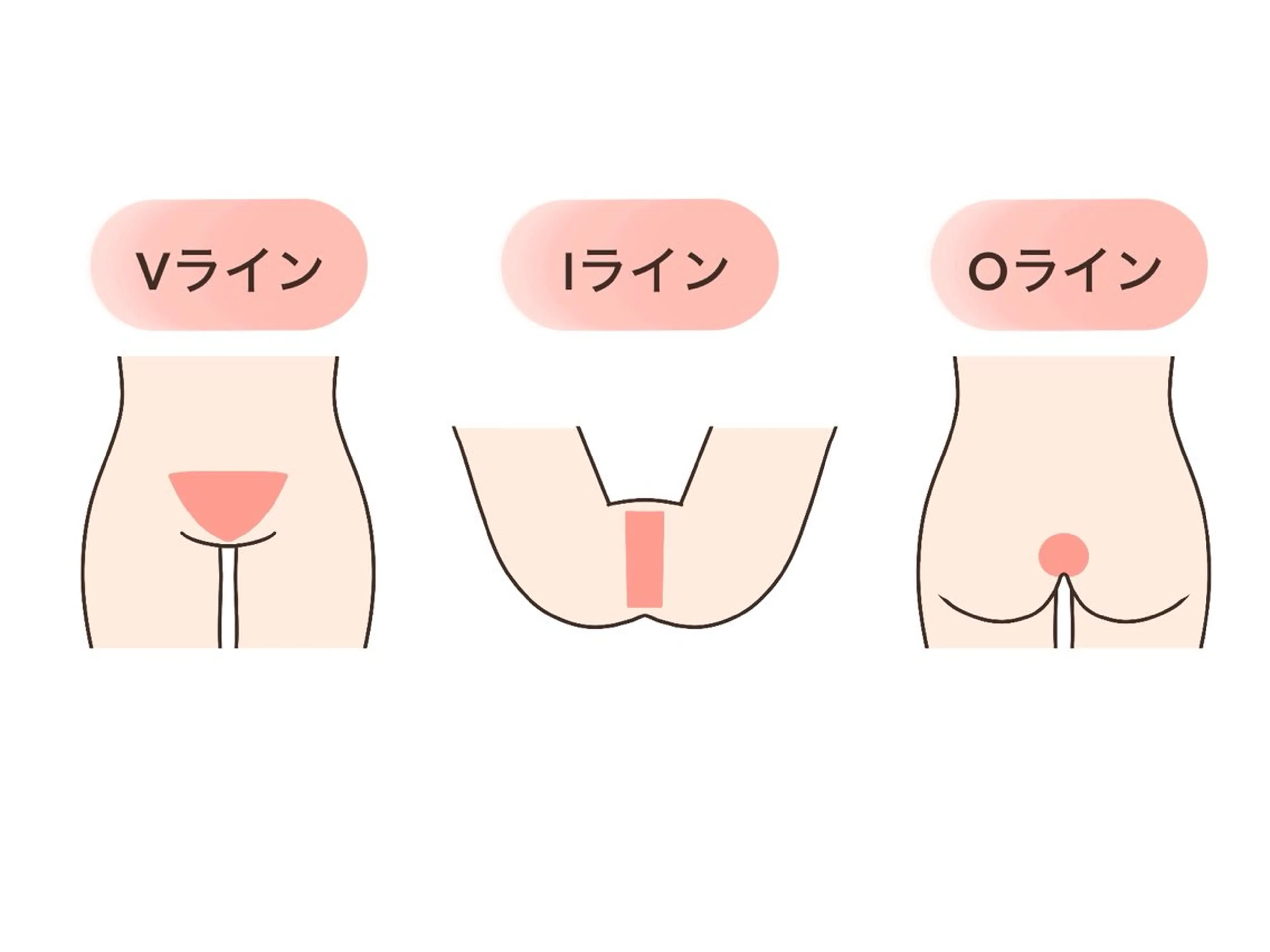 【レディース】ワックス脱毛VIO/デザイン可能！毛量により割引き制度あり◎イベント前の特別価格☆の写真