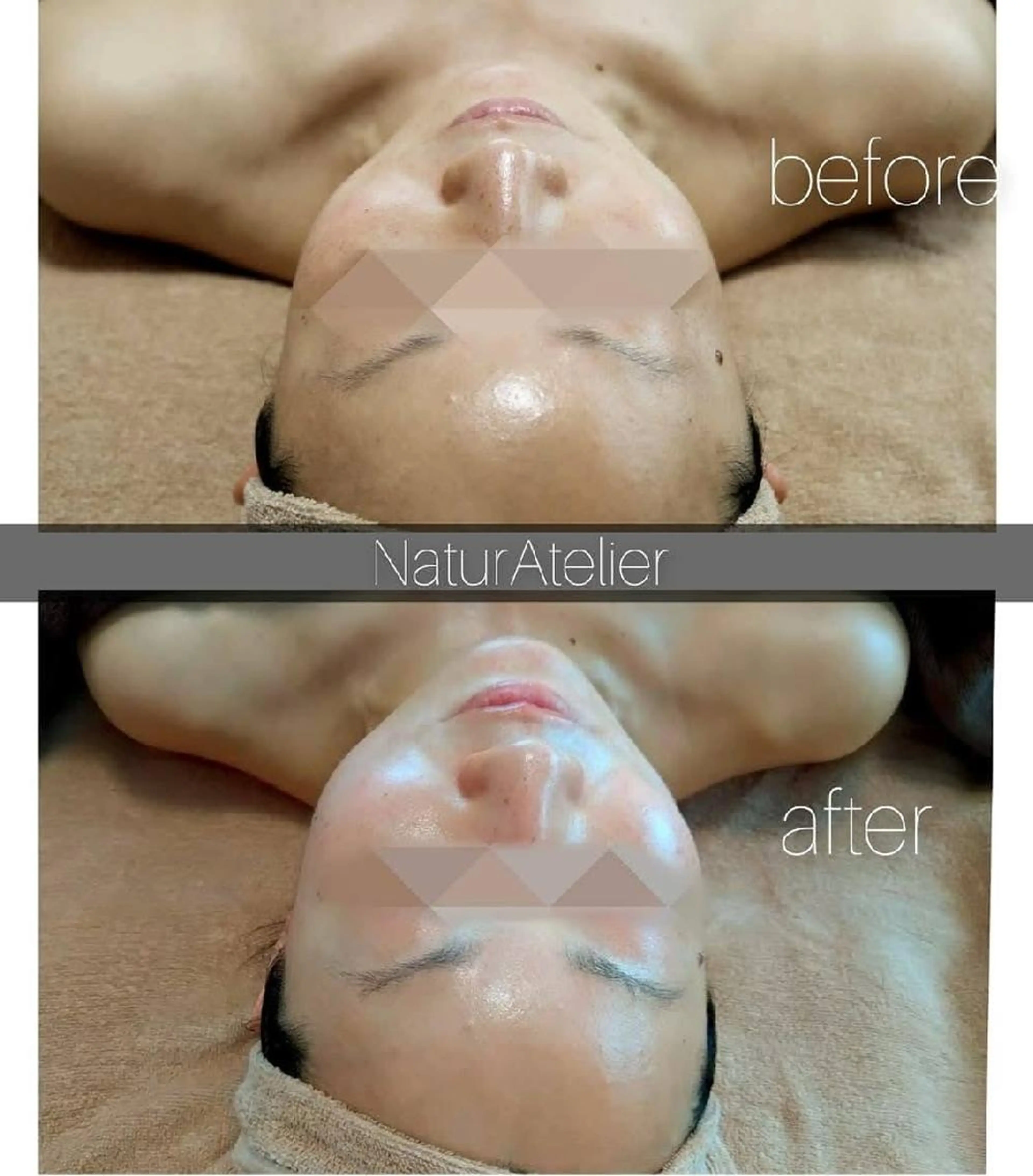 小顔コース症例モデル・モニターさん募集⭐《before/after》写真のご提供をお願いします。の写真