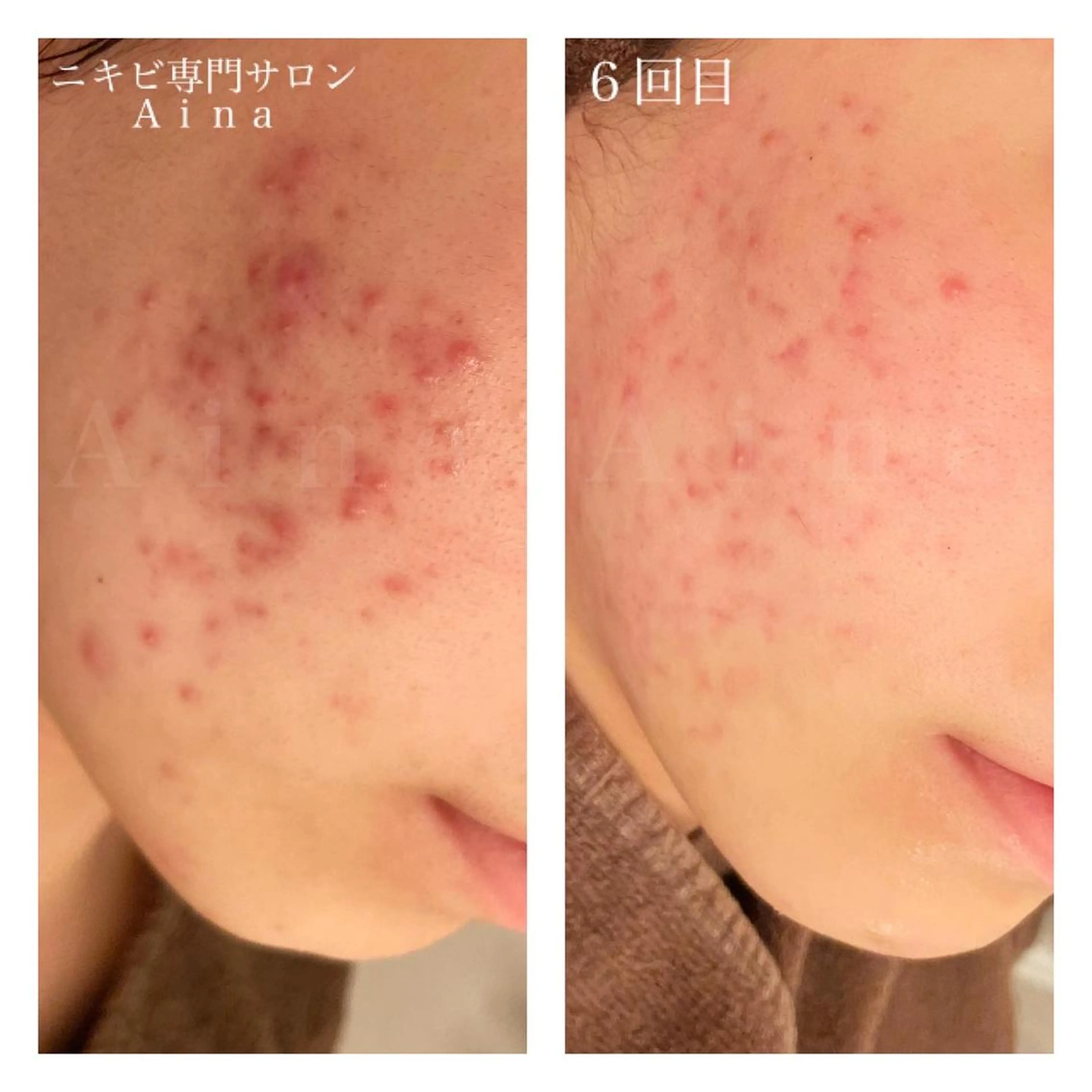 セミロング カラー パーマ ヘアアレンジ メンズ キッズ ネイル マツエク・マツパ 赤色 エステ リラク ニキビ跡専門サロン Ａｉｎａのエステ・リラクイメージ