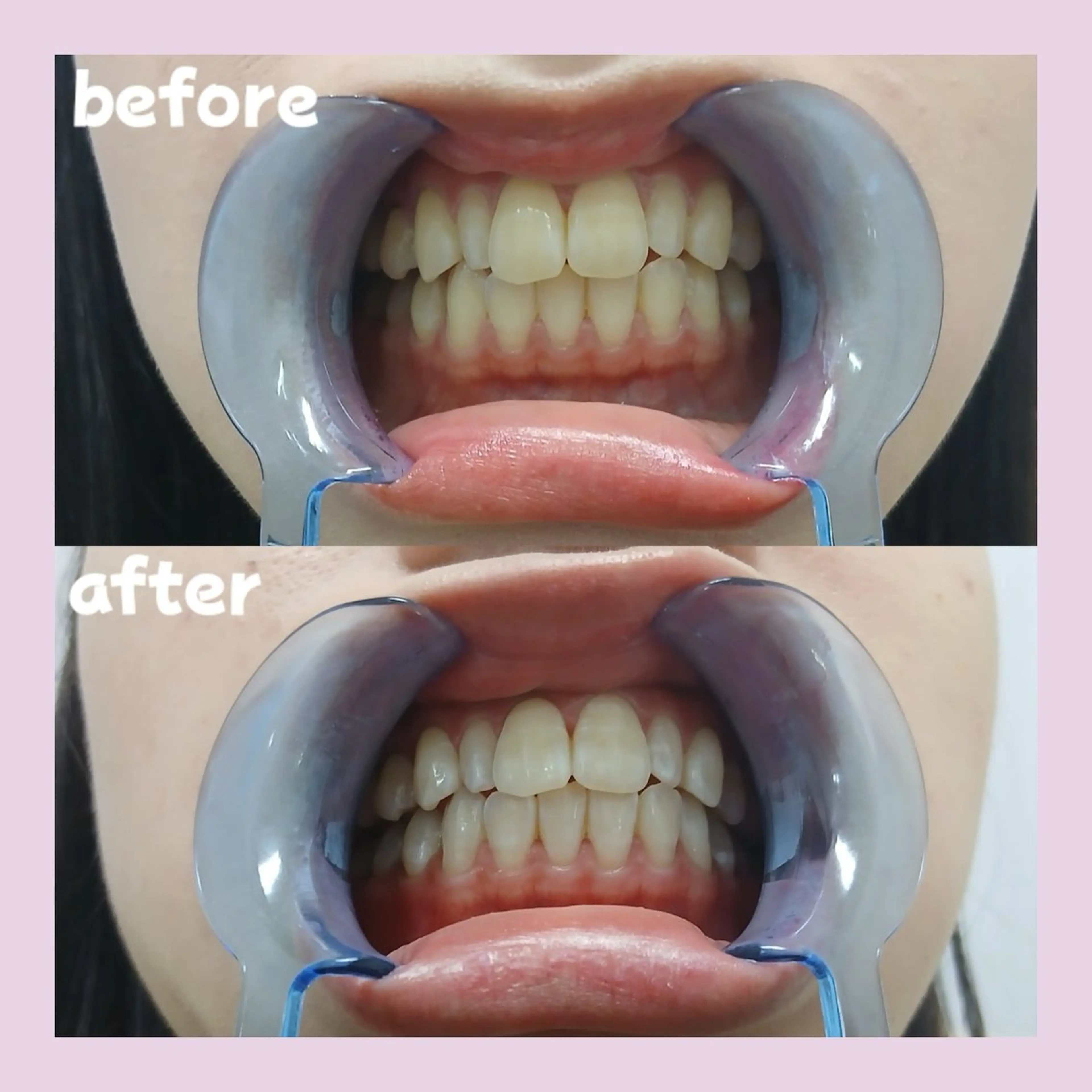 メンズ セルフホワイトニングサロンPalet【パレ】所属・太田 菜那のその他イメージ