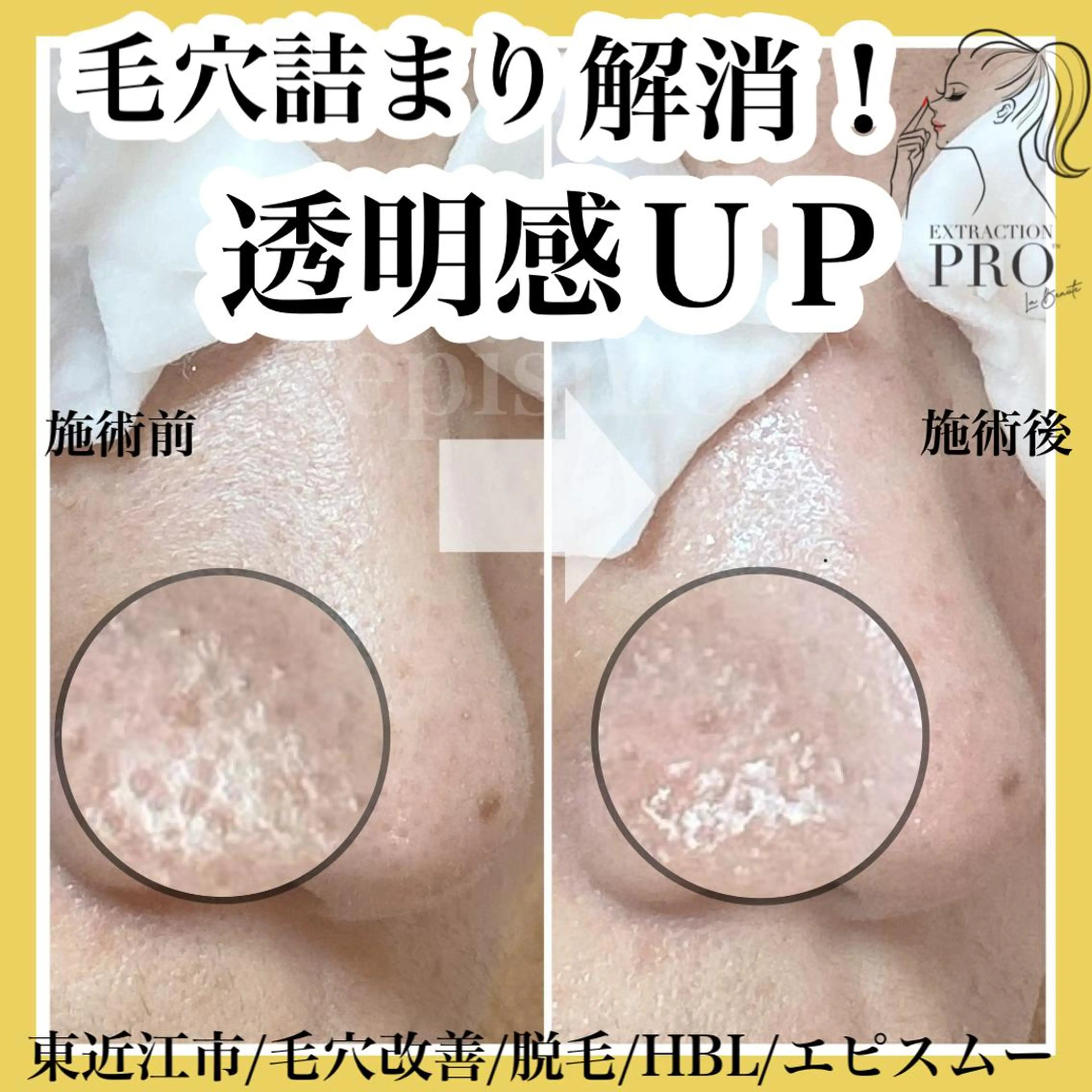 epismoo 脱毛/HBL/毛穴の眉毛・アイブロウイメージ