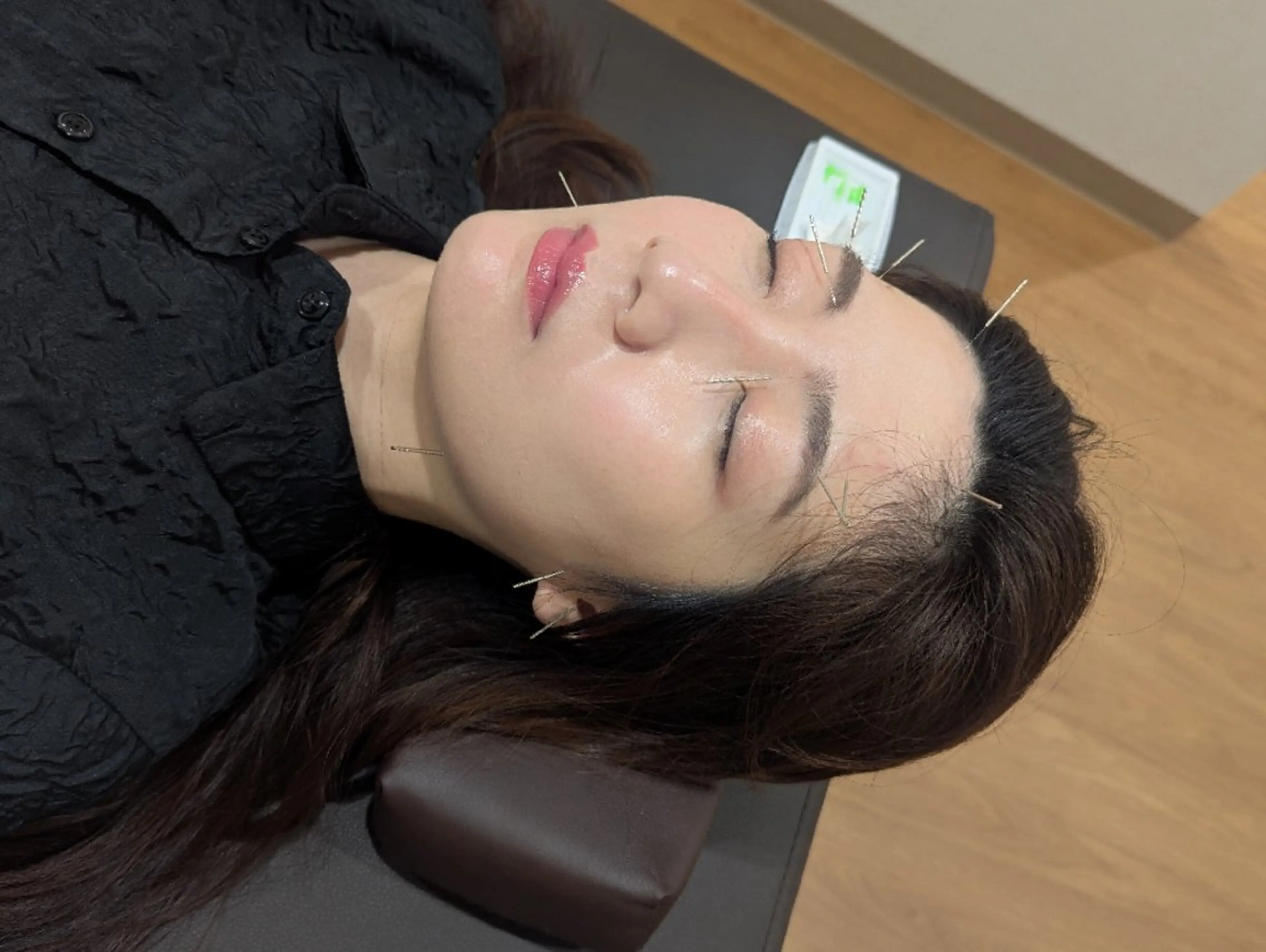 まぶたのたるみリフトアップに効果的!美容鍼+ドライヘッドヘッドスパの写真