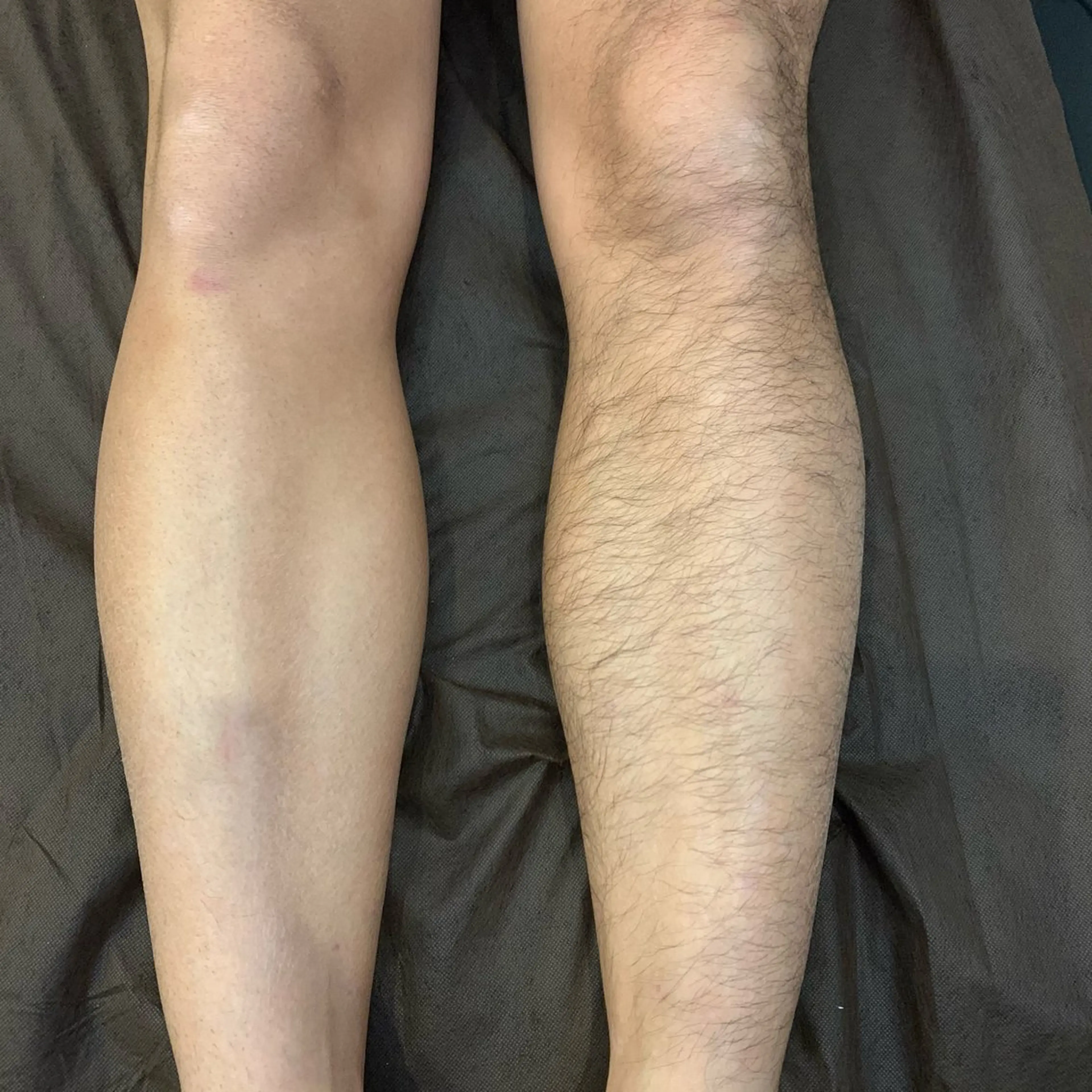 脚まるごとor腕まるごと　脱毛の写真