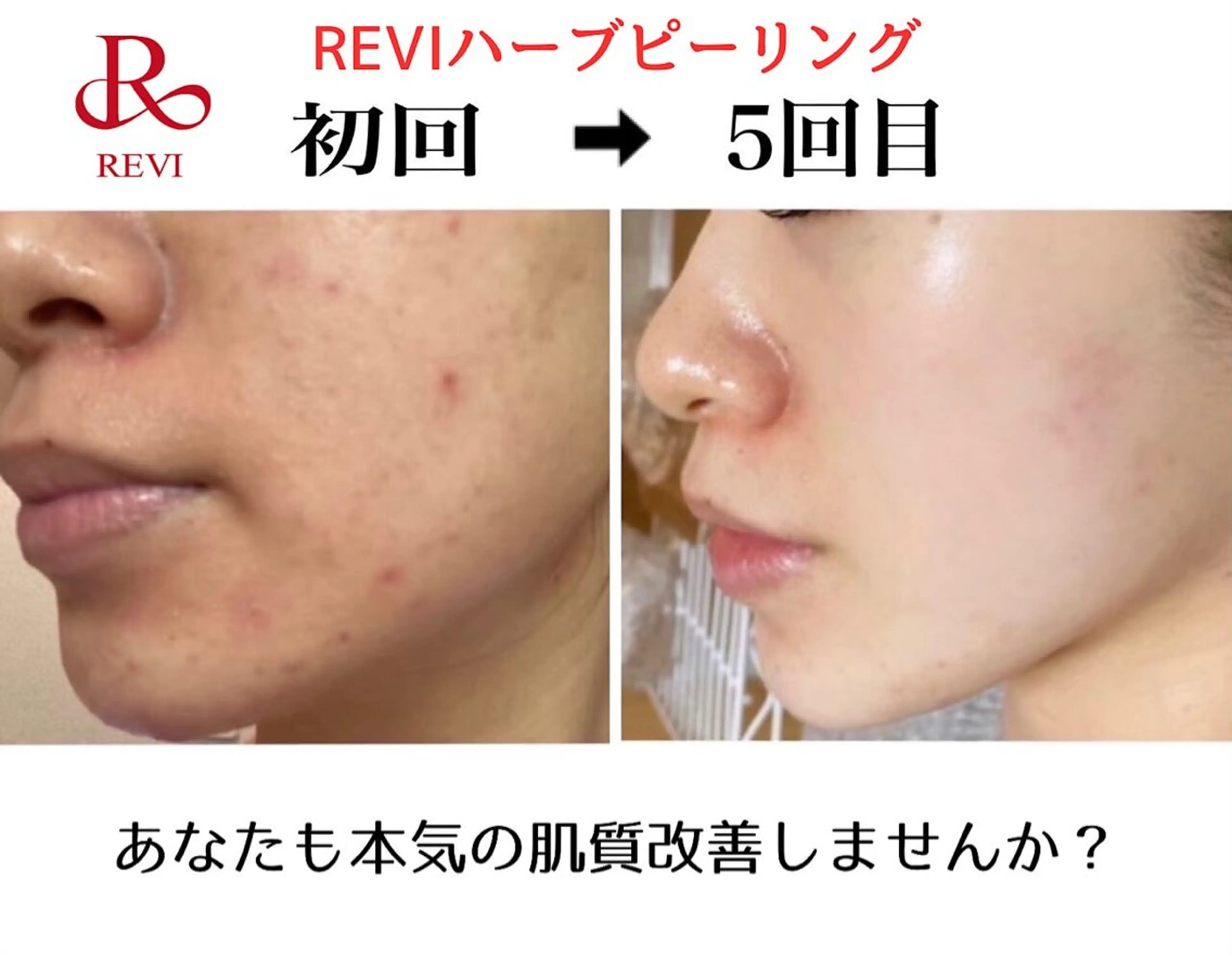 エステ ハーブピーリング専門 毛穴洗浄❤️眉waxのエステ・リラクイメージ