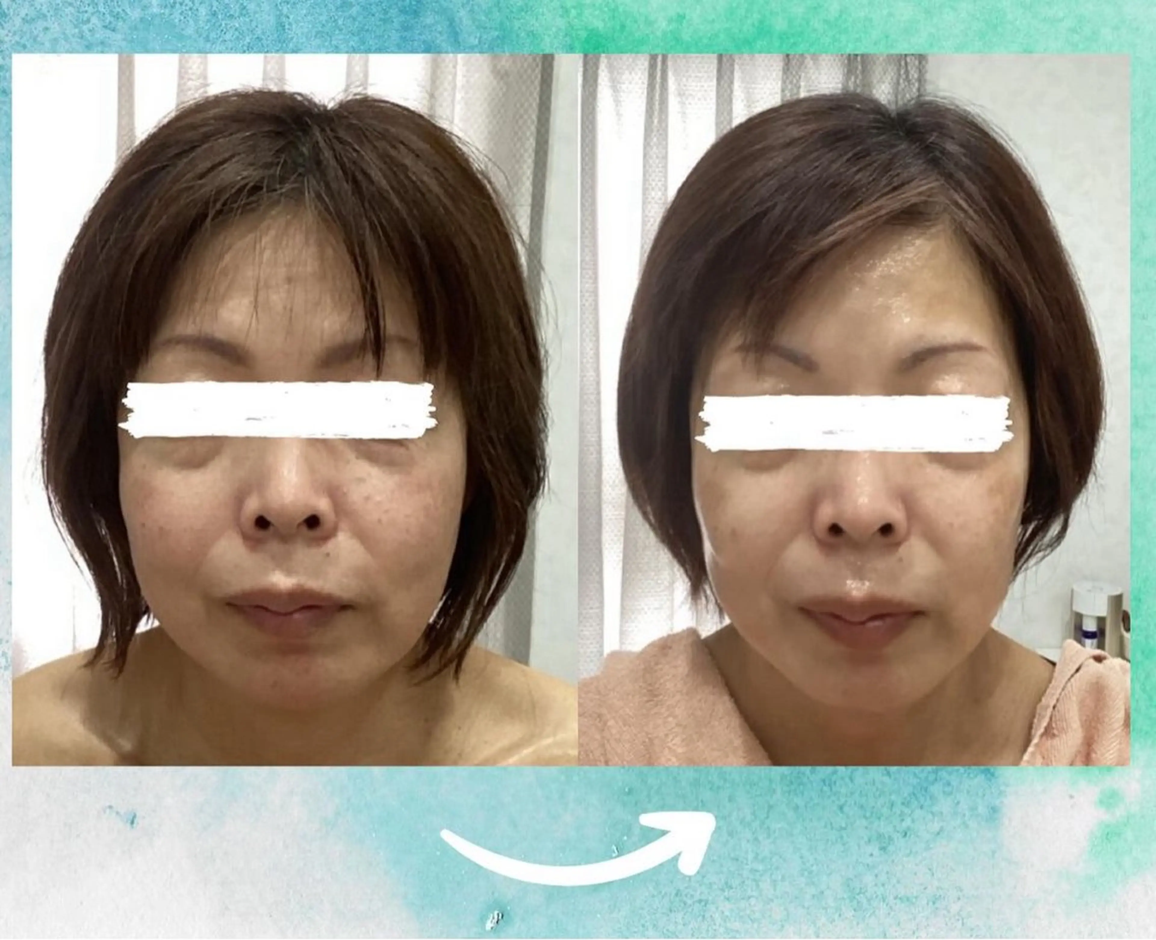 【透き通るような透明感を】🤍徹底美白シミケア体験🤍[兵庫県尼崎市/痩身エステ]の写真