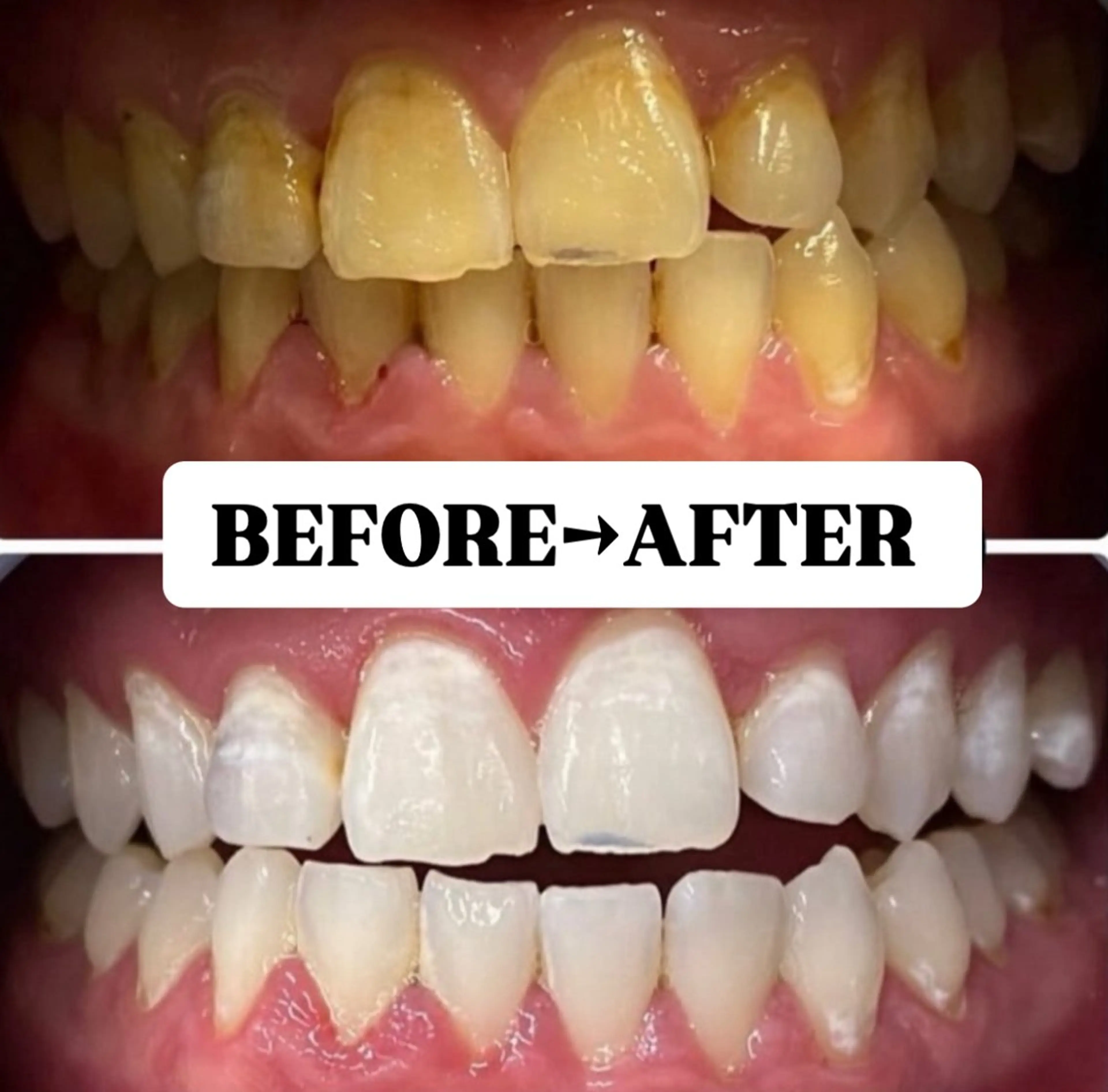 【回数券お持ちの方限定】美白セルフホワイトニング¥0の写真