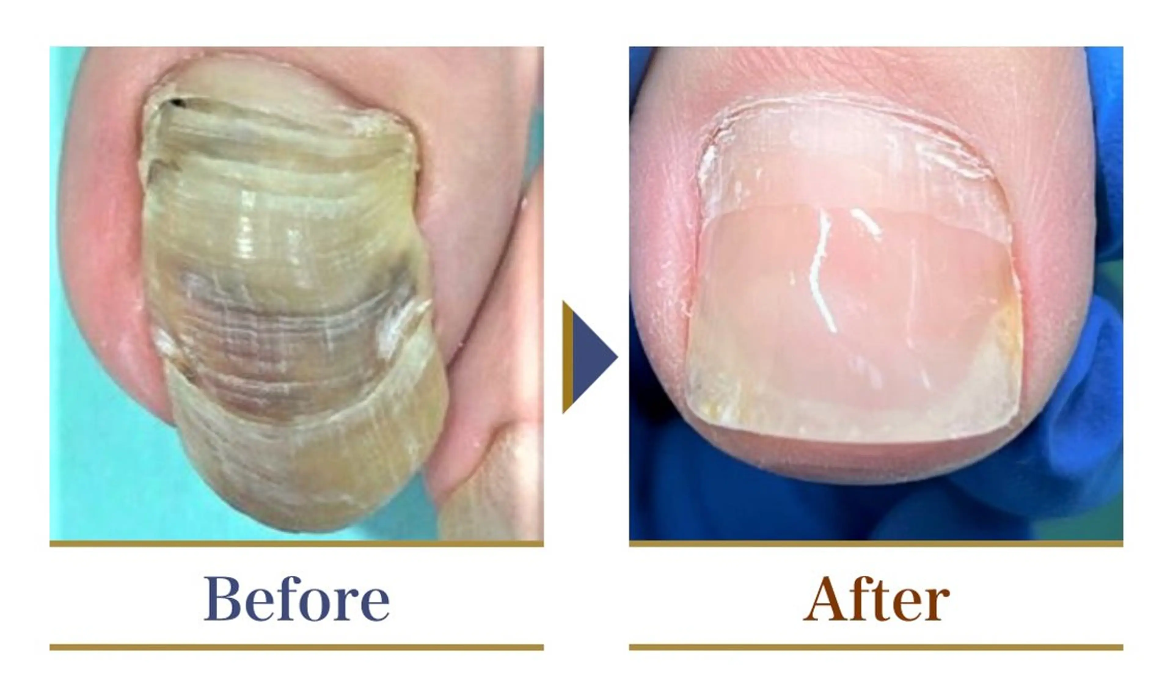 巻き爪補正店 横浜関内店のネイルデザイン