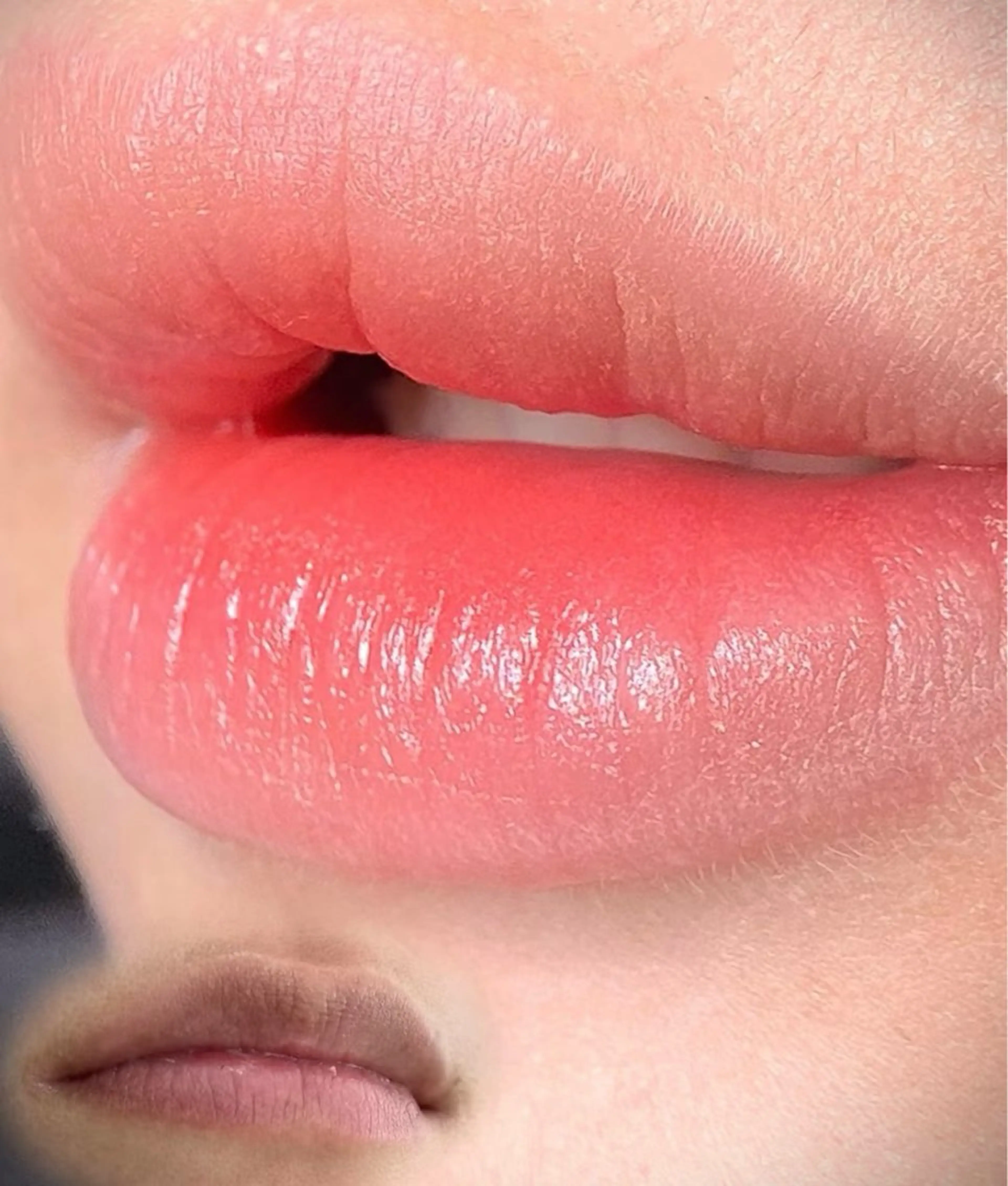 【ローマ ピンク】日本・海外でも話題の色素沈着ケア◆諦めていた黒ずみ改善の写真