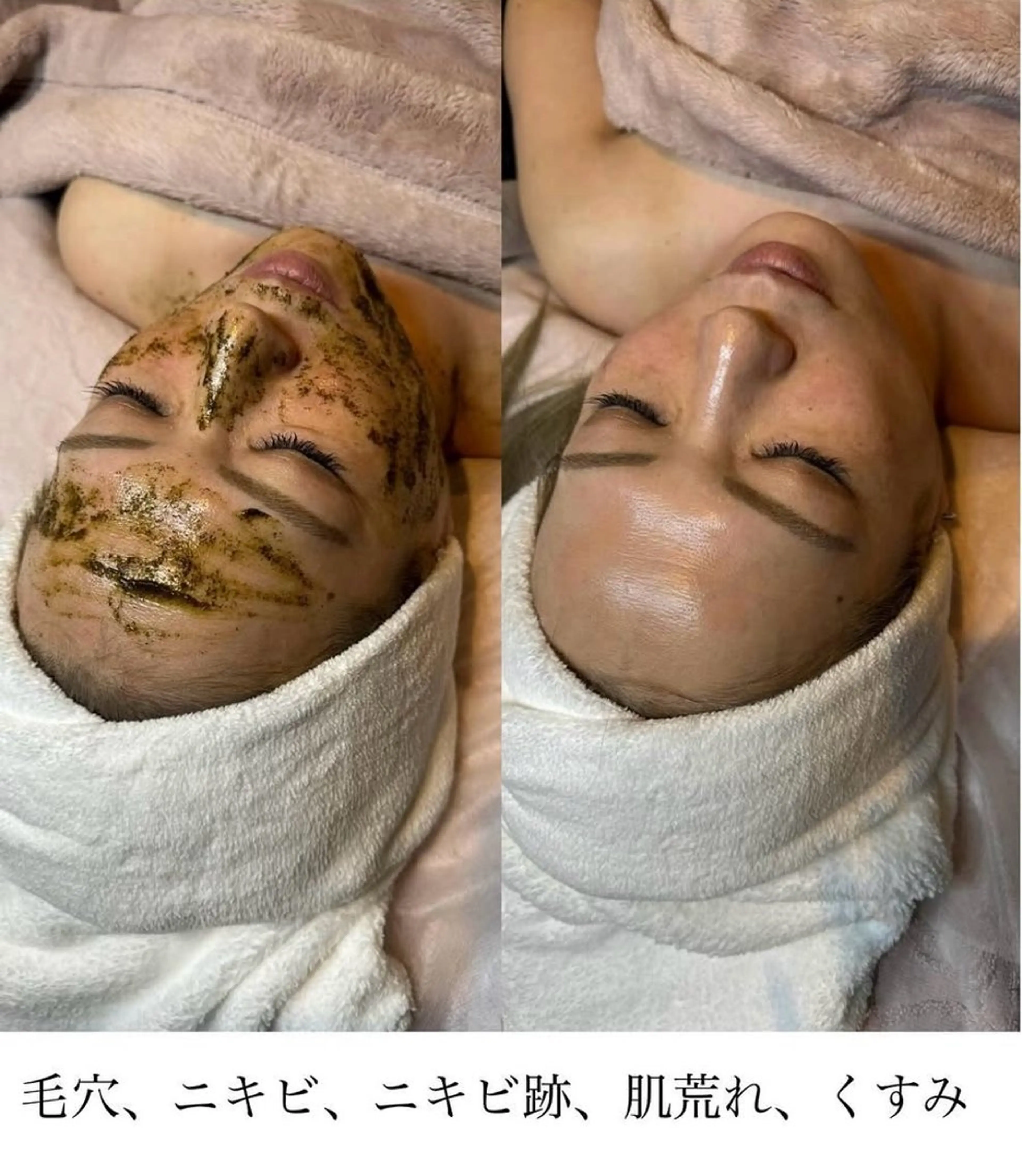 ハーブピーリング(剥離・ダウンタイム無し) ニキビ・毛穴・むくみの気になる方にの写真